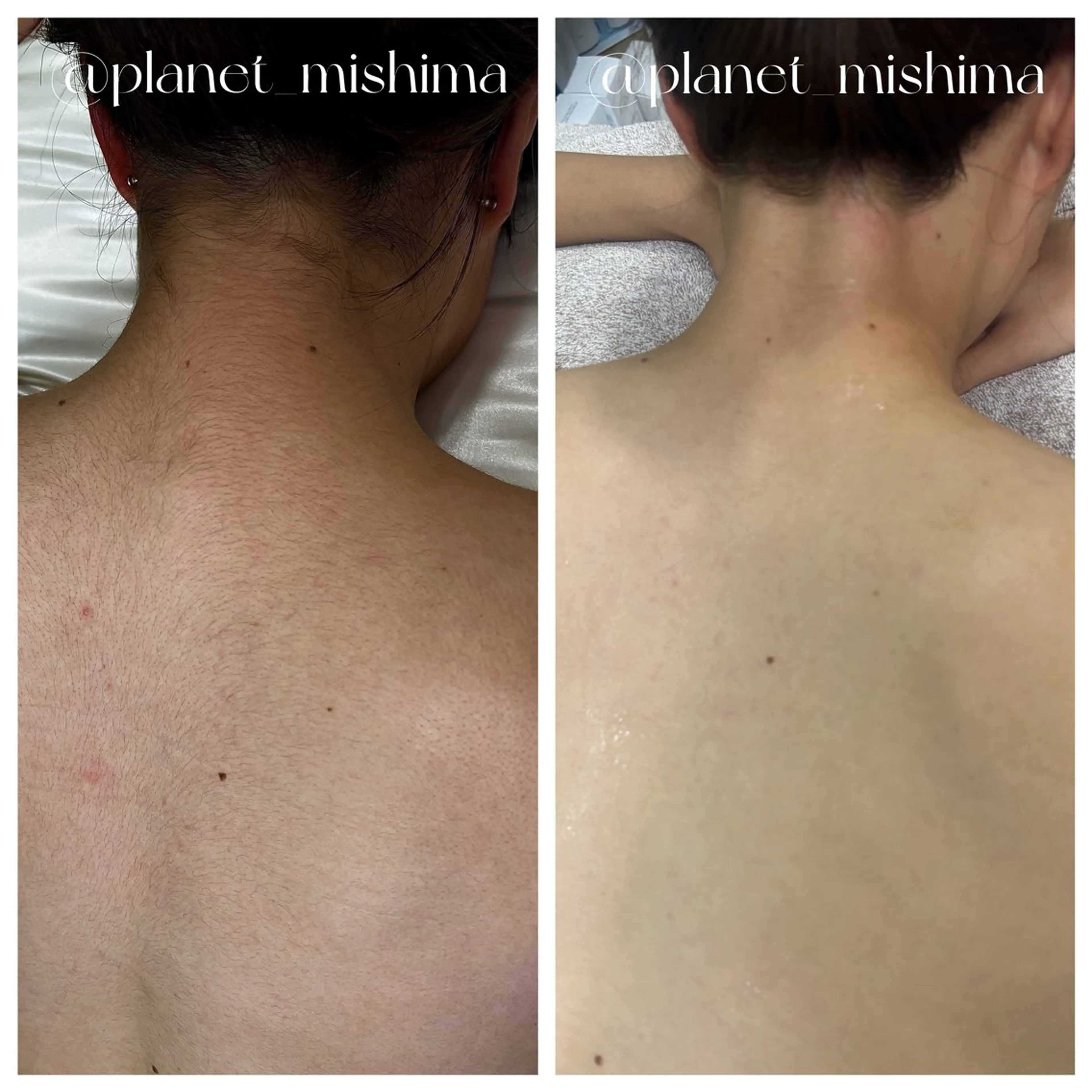 【背中美人】うなじ×背中上部WAX【天然マツヤニ】の写真