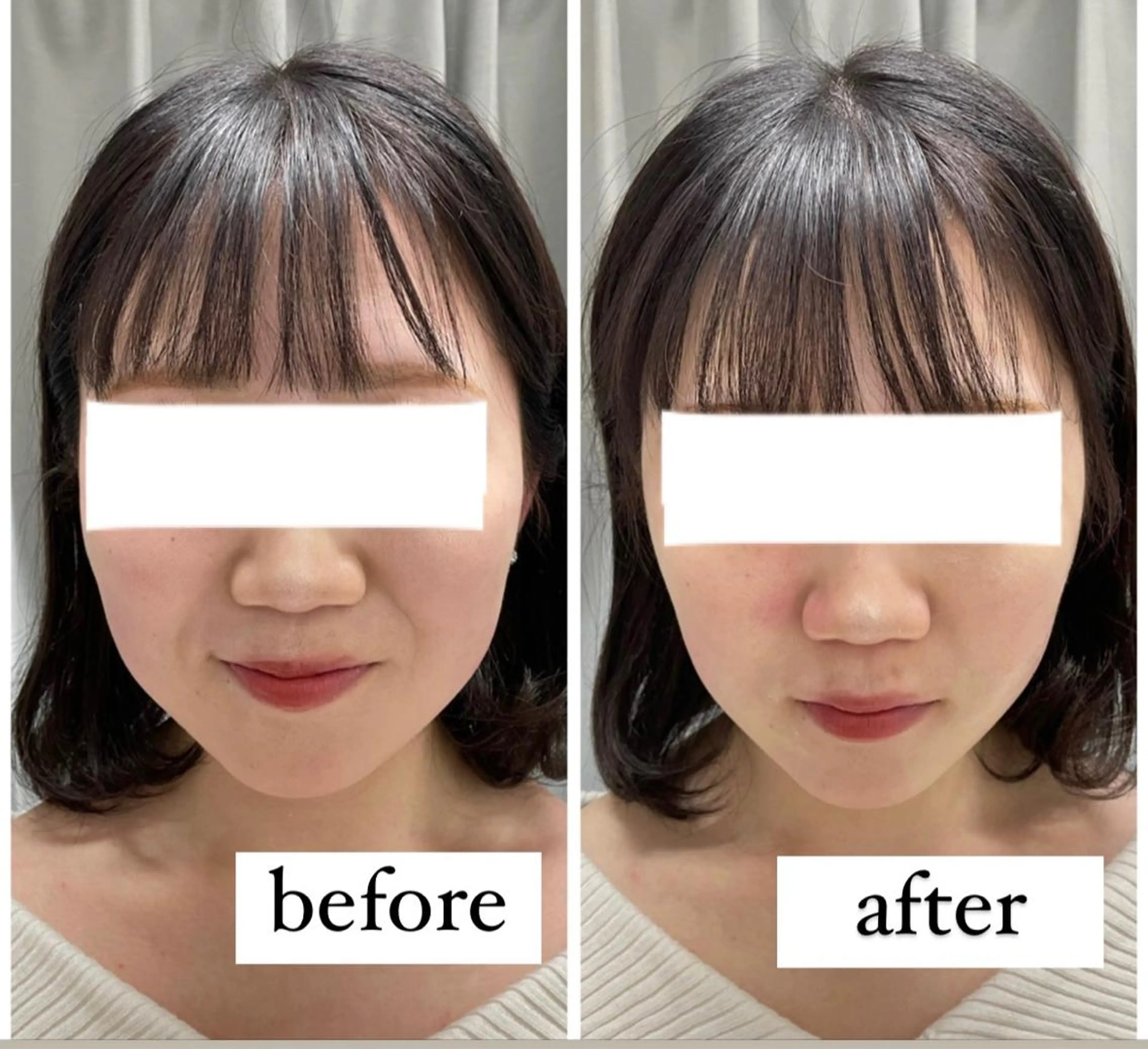 【リフトアップ／即効小顔】3D超音波リフト☆7500ショット😊の写真