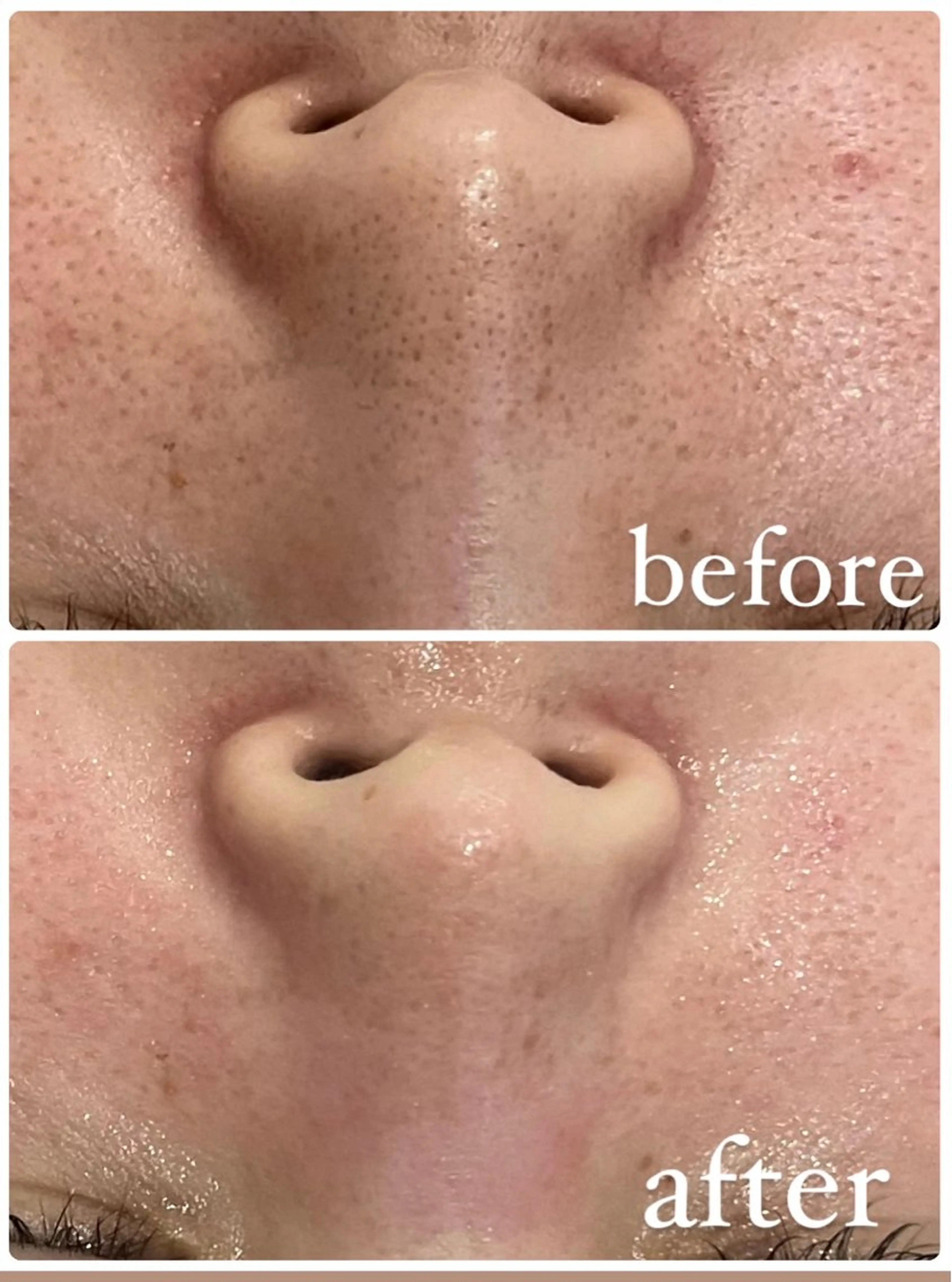 【毛穴洗浄毛穴集中ケアコース】（選べる毛穴ケアパック付）🌿黒ずみ、詰まり、開き、ザラつき気になる方へ👃の写真