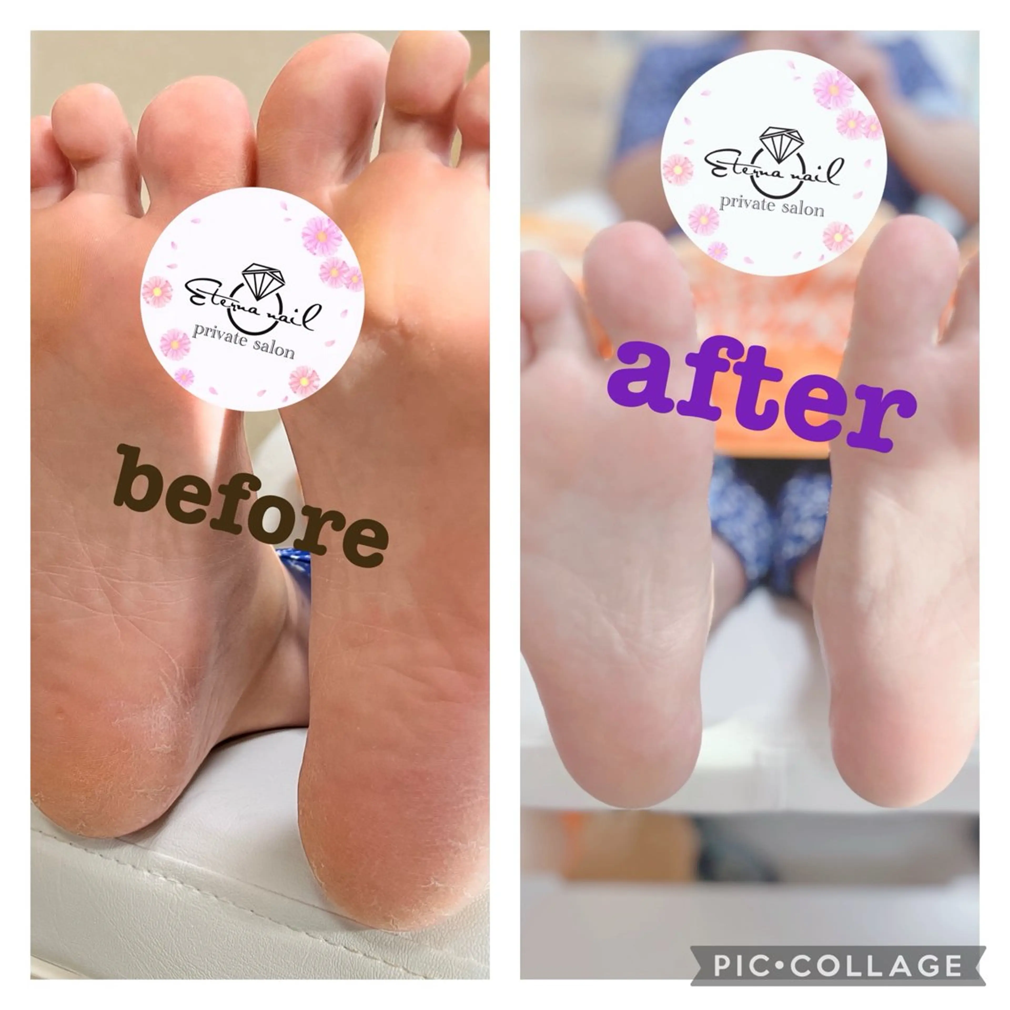 夏にぴったり☀️フット角質ケア‼️の写真