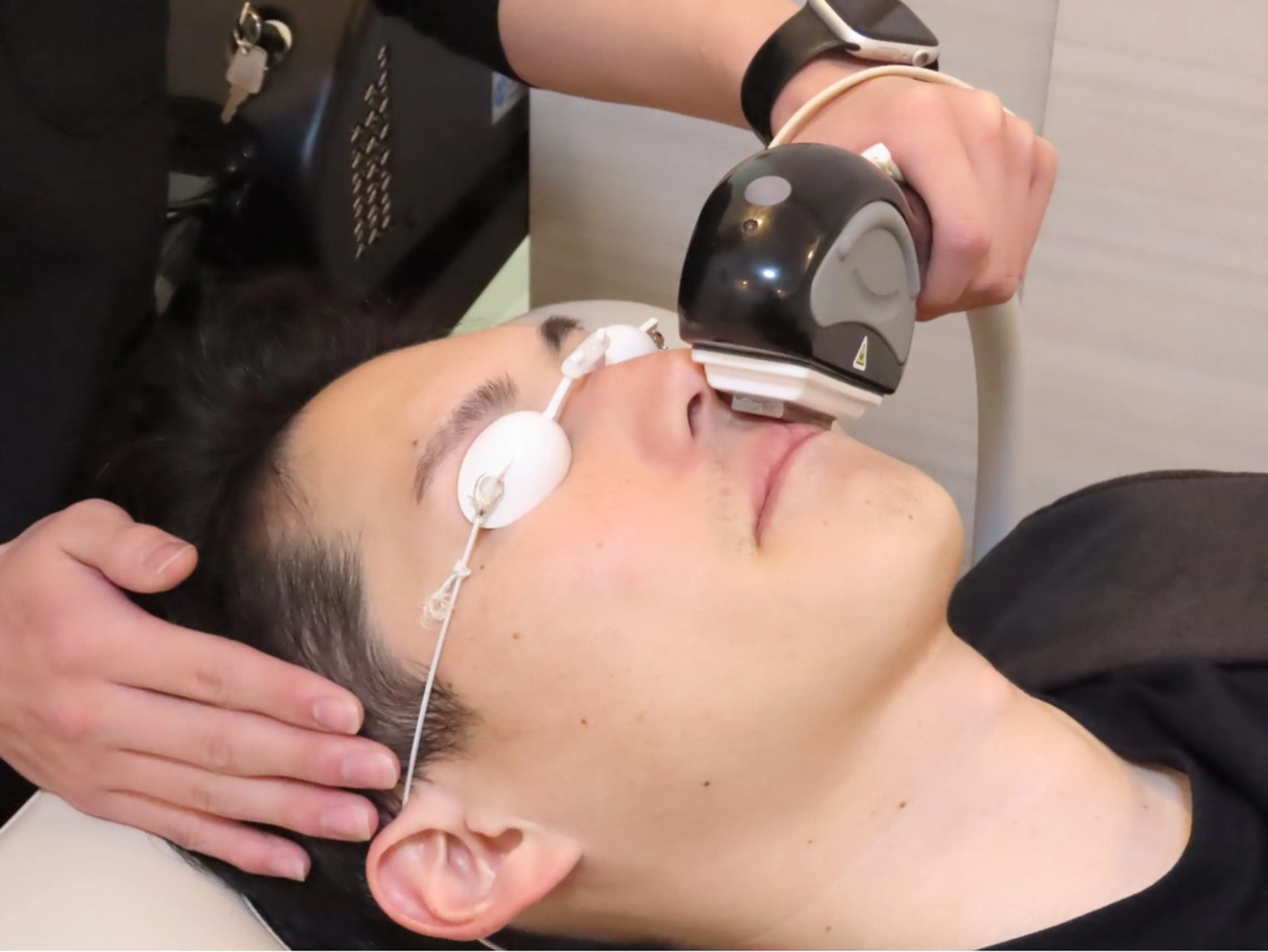 メンズヒゲ脱毛の写真