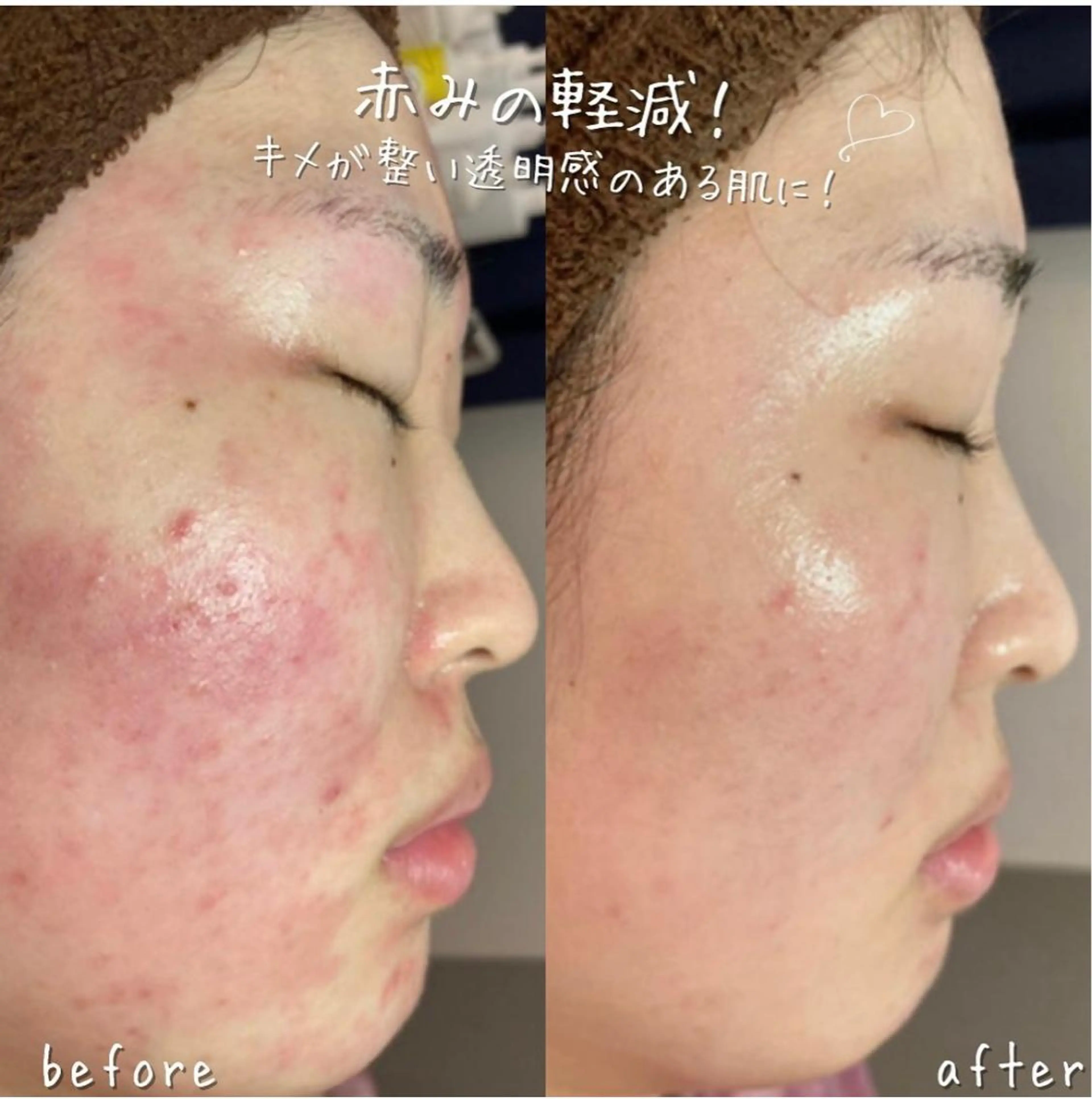 【ミニモ限定特別価格‼︎】水光美白な韓国人肌に🫧ハーブピーリング＋お肌の赤み・キメ・炎症を抑えるシルクパウダー付き🌷の写真