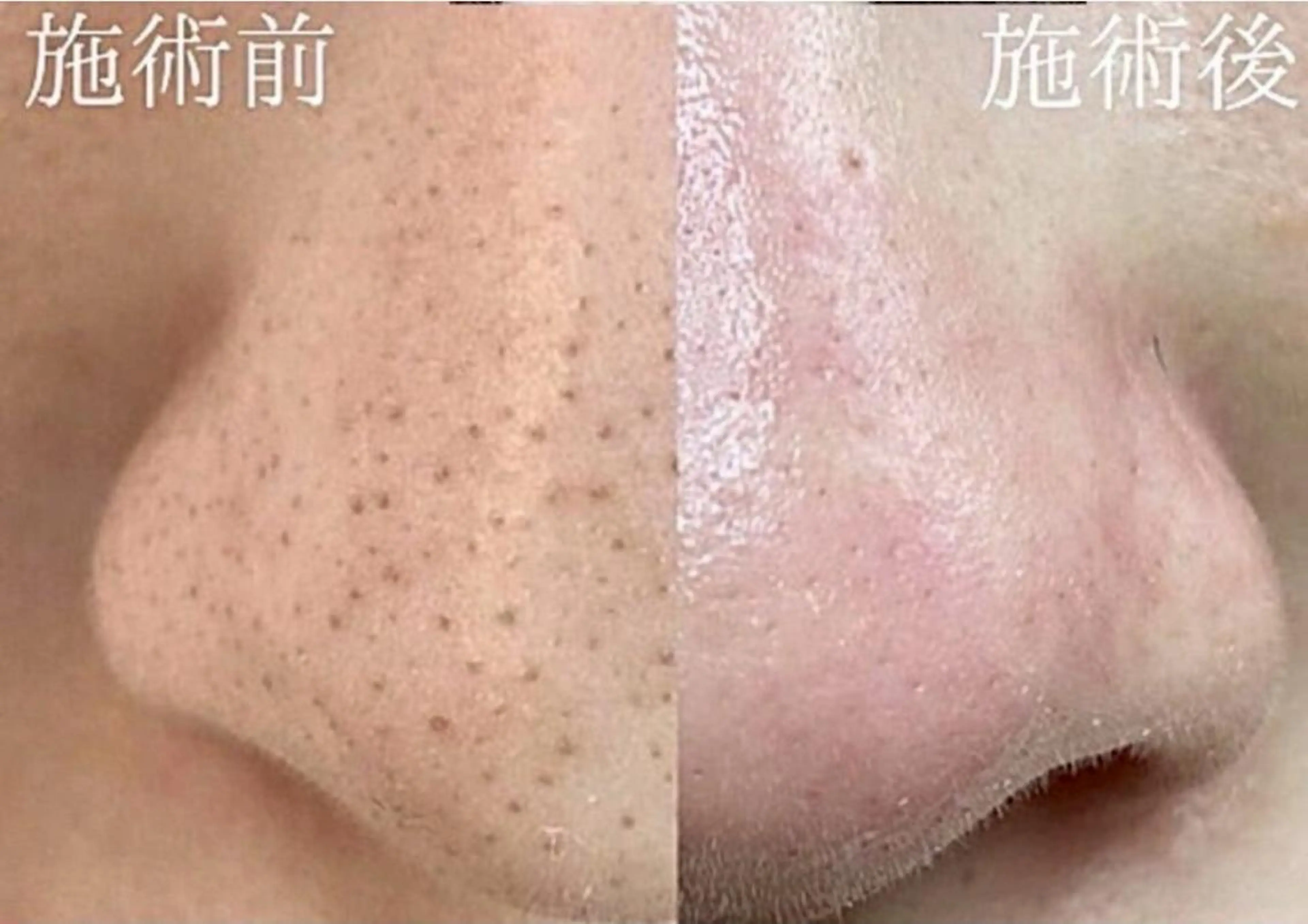 エステ 毛穴/毛穴洗浄専門 エミルカ船橋のエステ・リラクイメージ