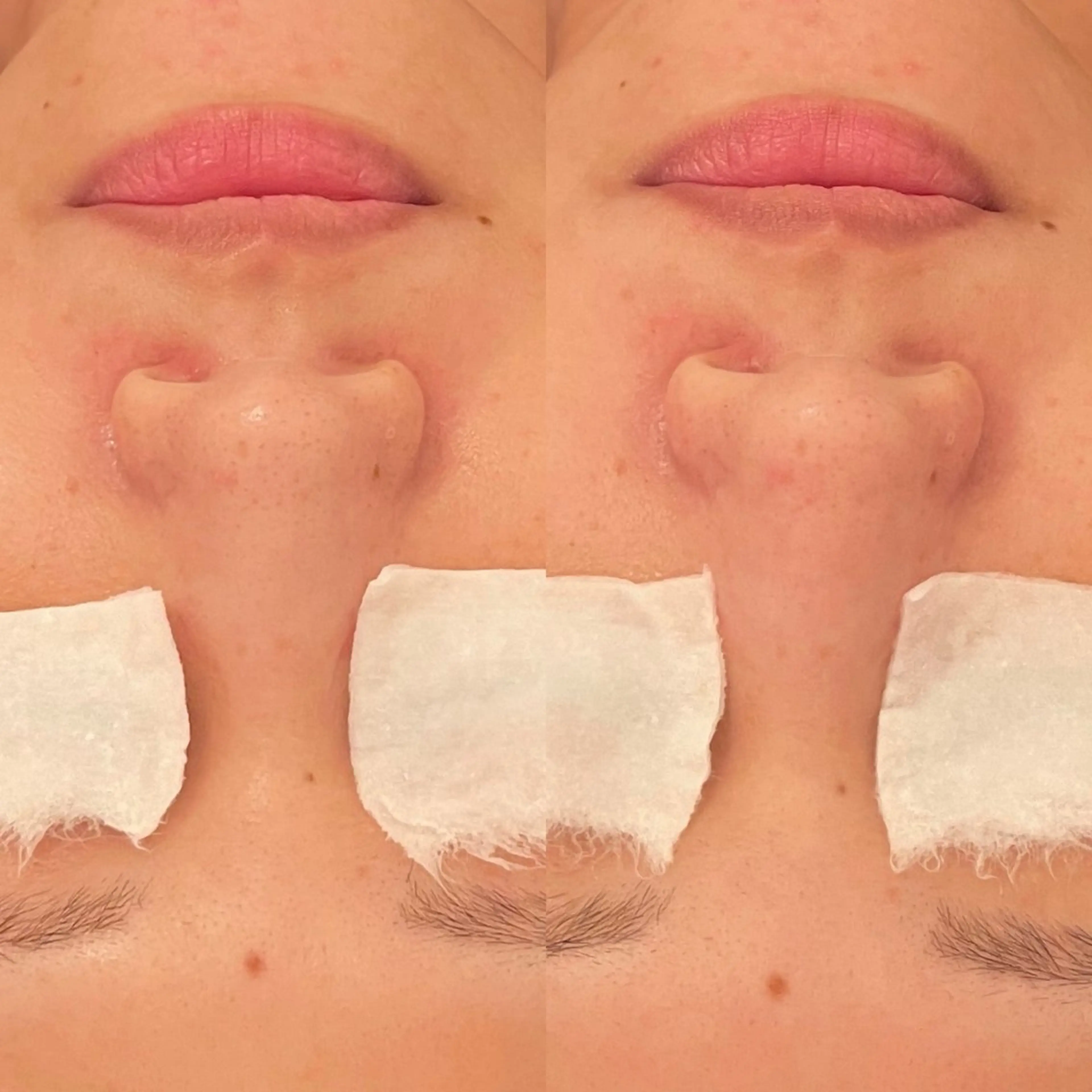 エステ 毛穴ケア/毛穴診断/ 毛穴洗浄〔心斎橋〕のエステ・リラクイメージ