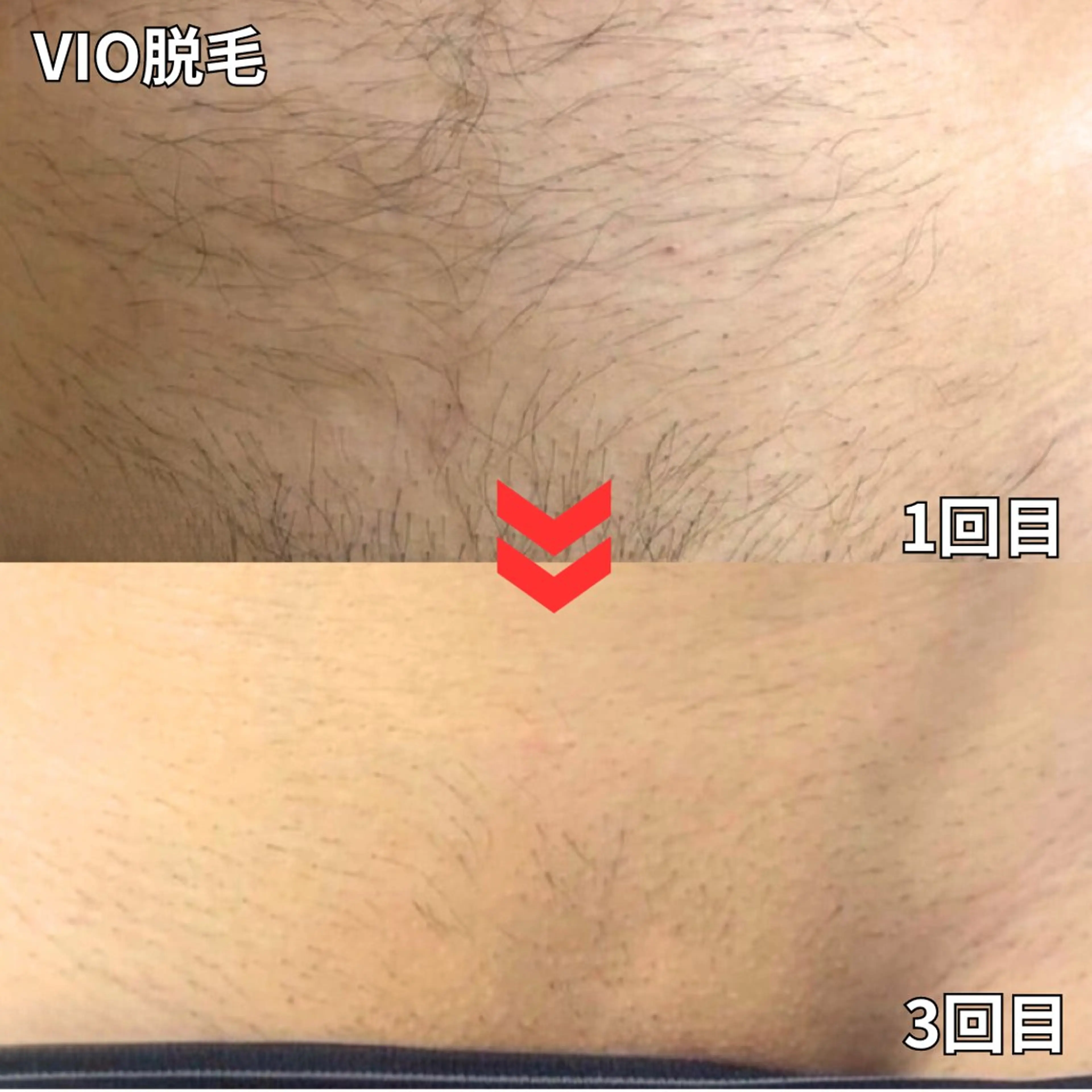 【ミニモ初回限定メンズ50%オフ✨】VIO脱毛の写真