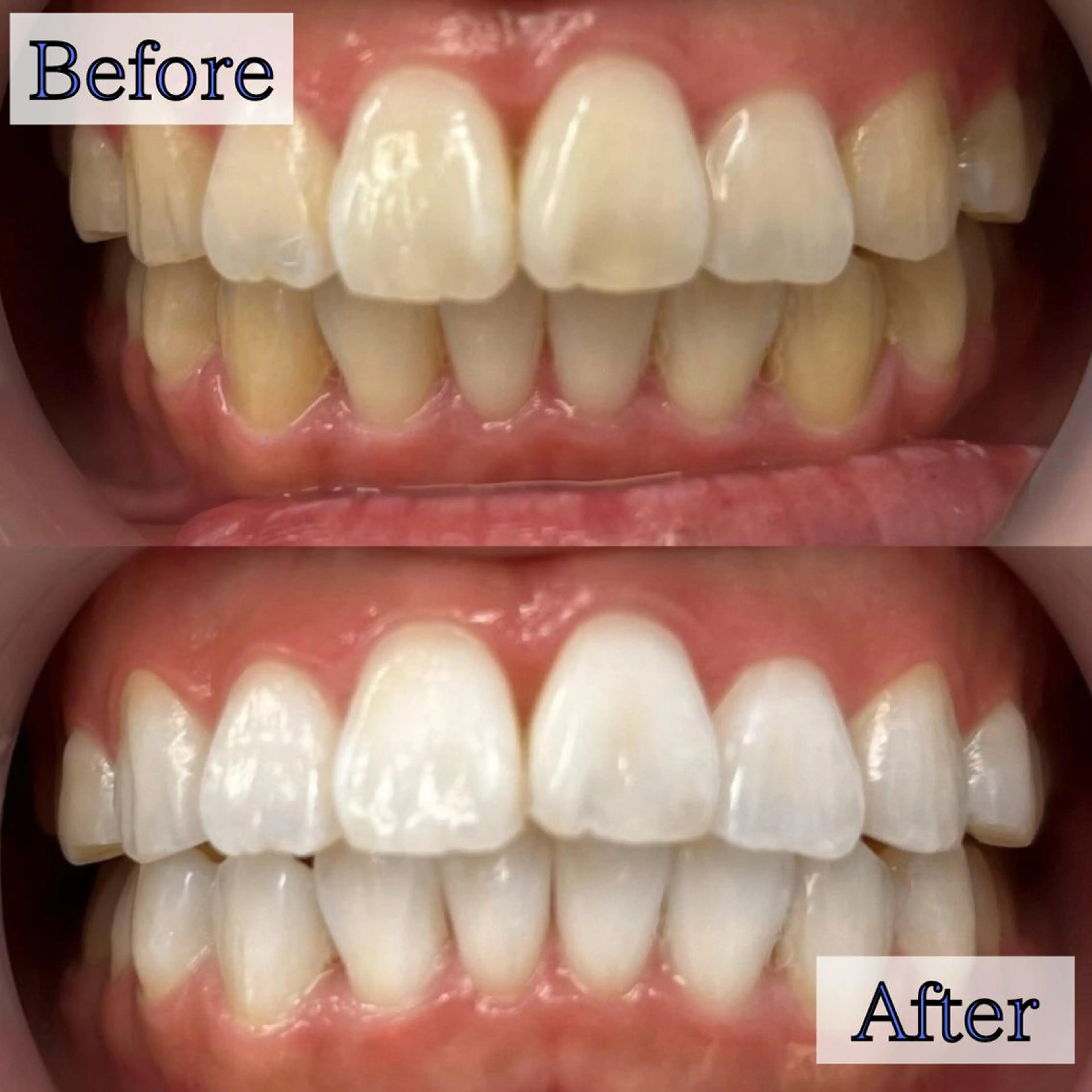 【💎効果実感💎】8分照射×4回✨効果を実感してスタートしたい方にオススメ❣セルフホワイトニングで白い歯に🦷の写真