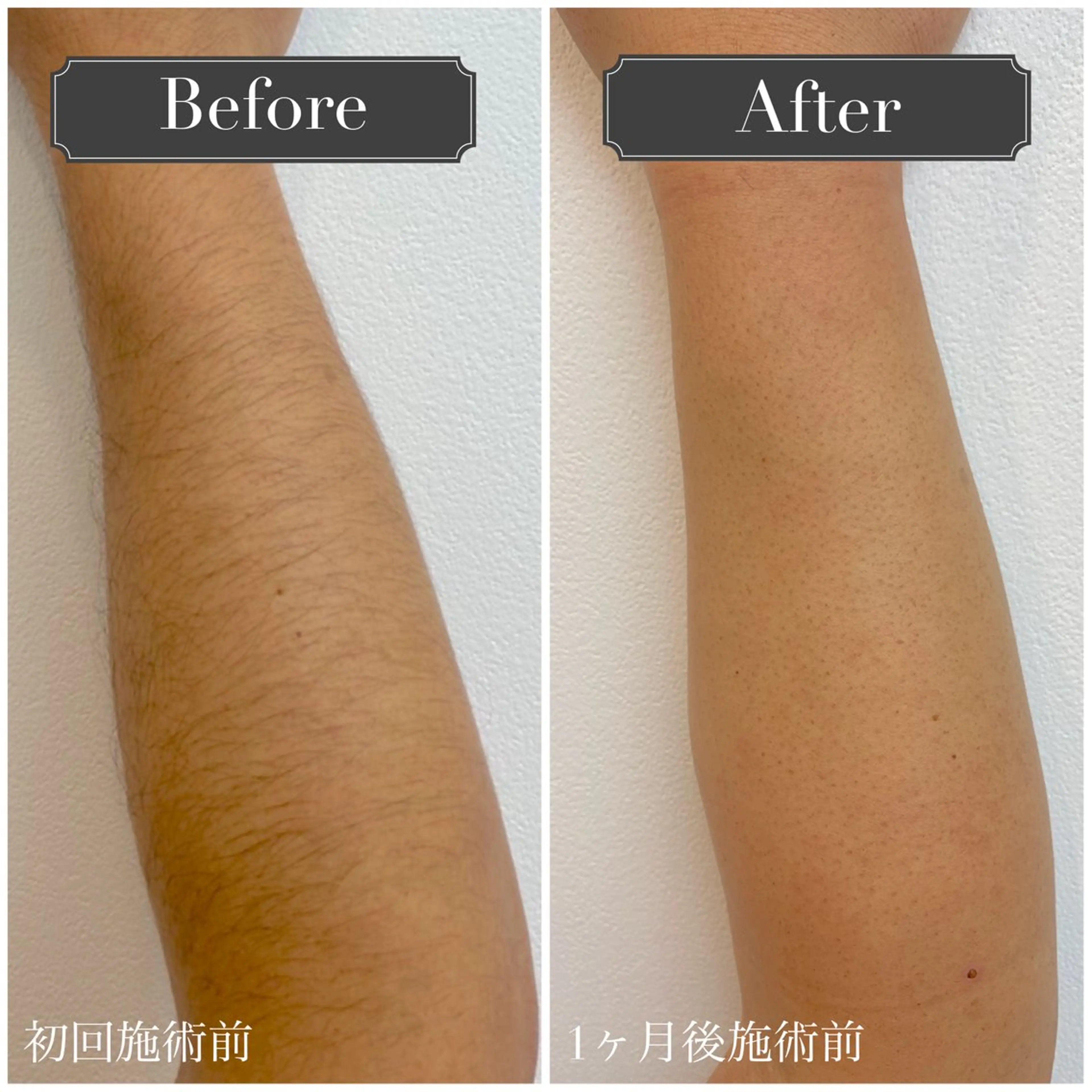 【新規】メンズ脚or腕脱毛¥3980の写真