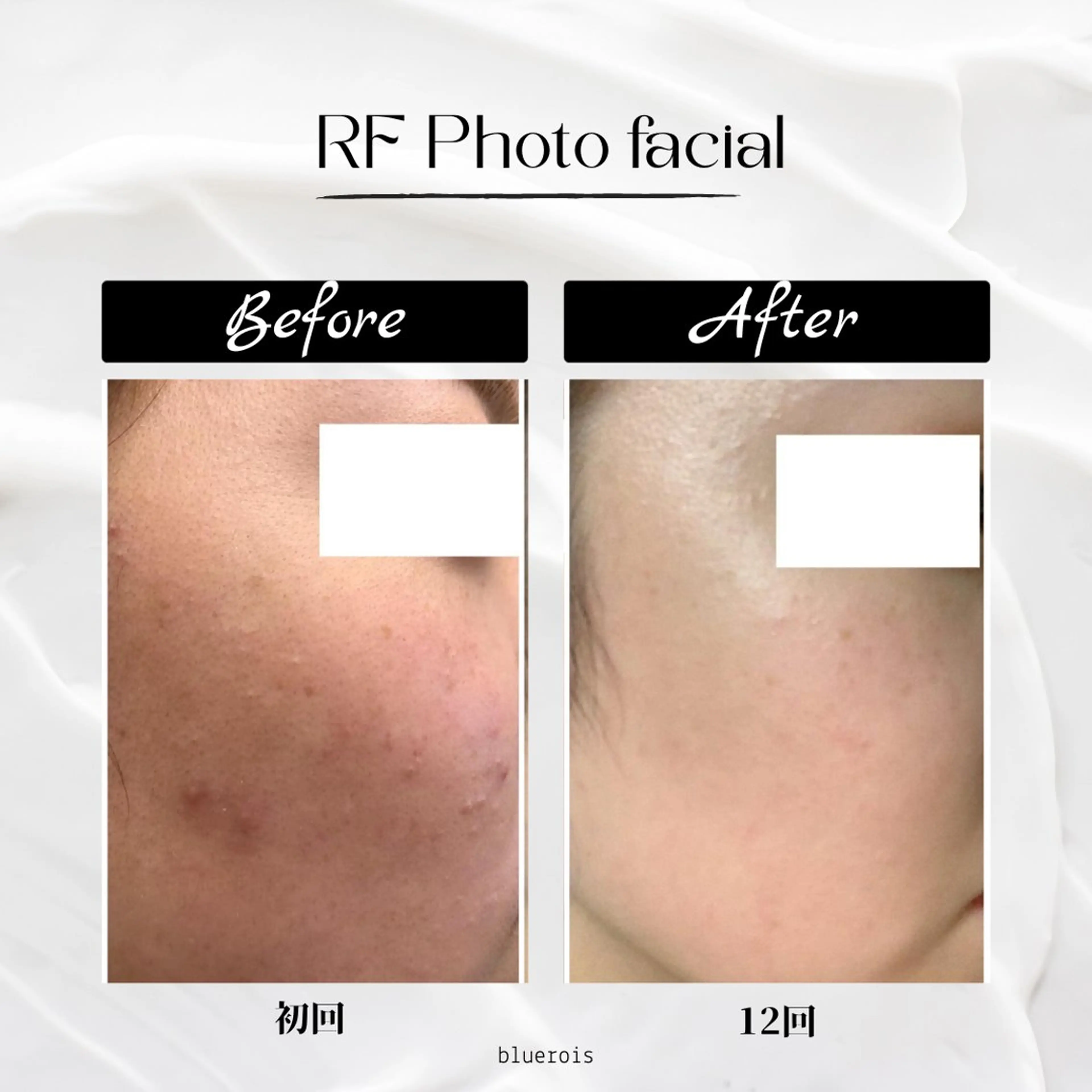 都度払いの脱毛サロンbluerois所属・都度払い専門サロン blueroisのエステ・リラクイメージ