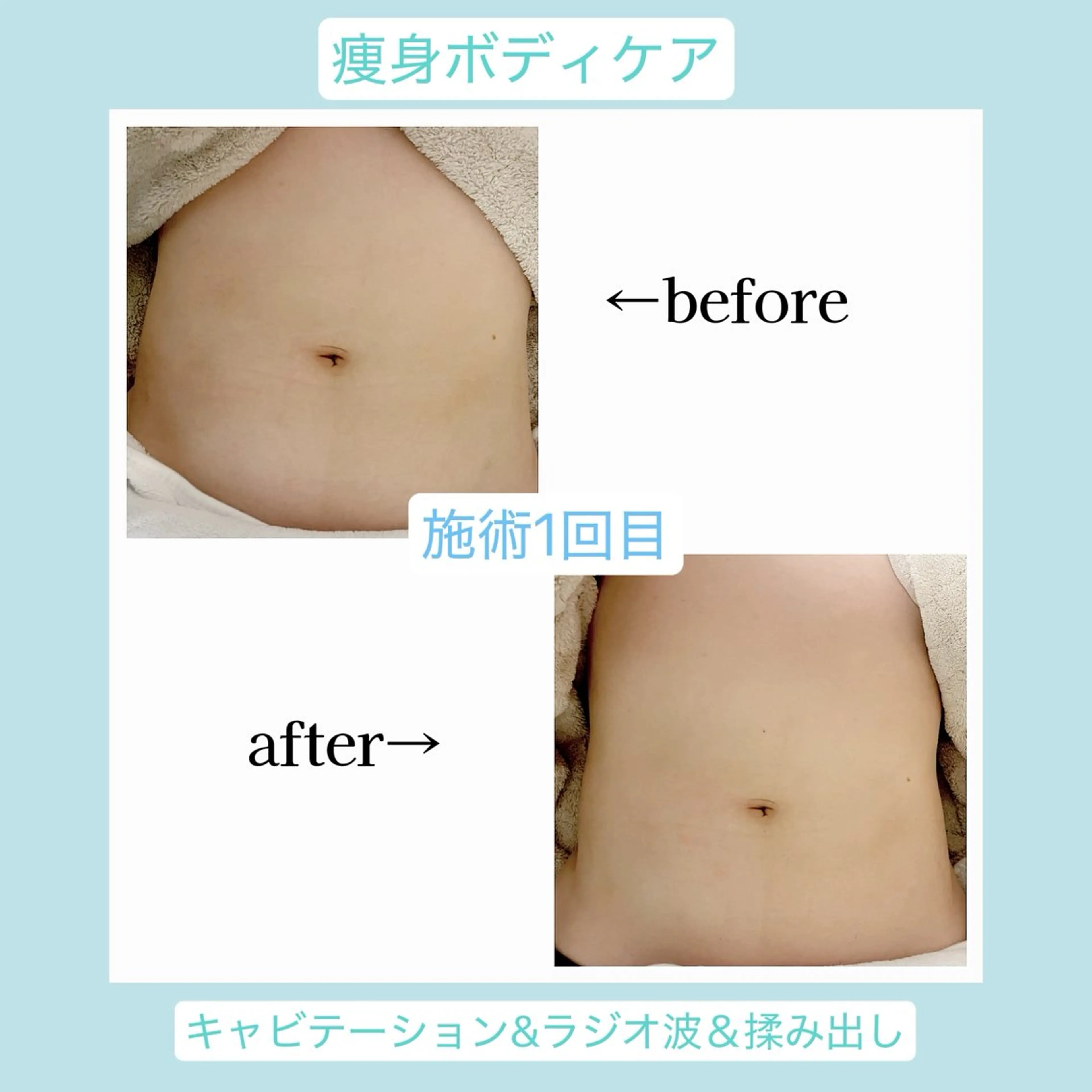 ✨モニター限定フルメニュー✨ 3時間で【痩身・バストケア・耳つぼ・ネイル】のトータルビューティーケア✨の写真