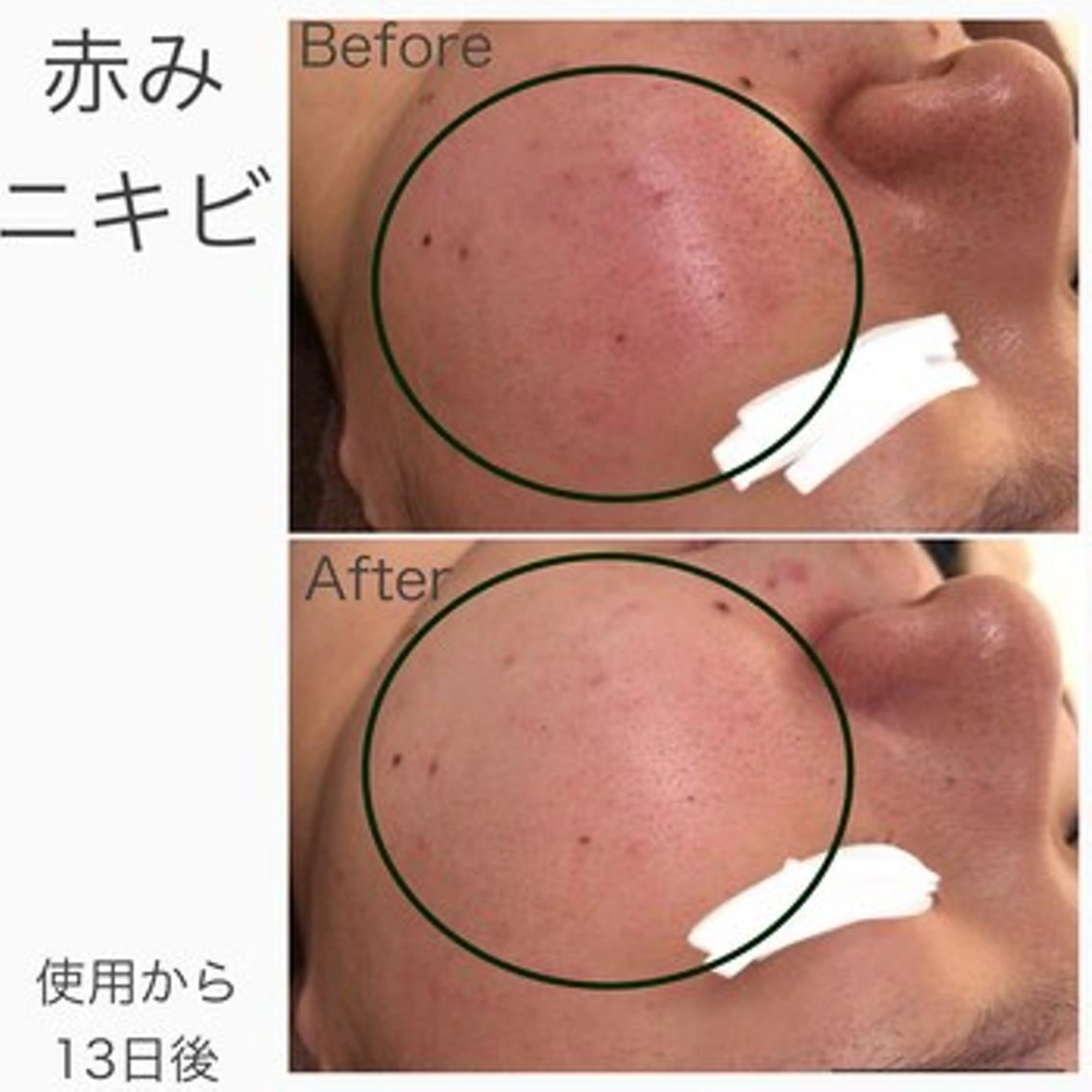 エステ リラク 🔥3か月で肌革命 🔥ニキビ専門店のエステ・リラクイメージ