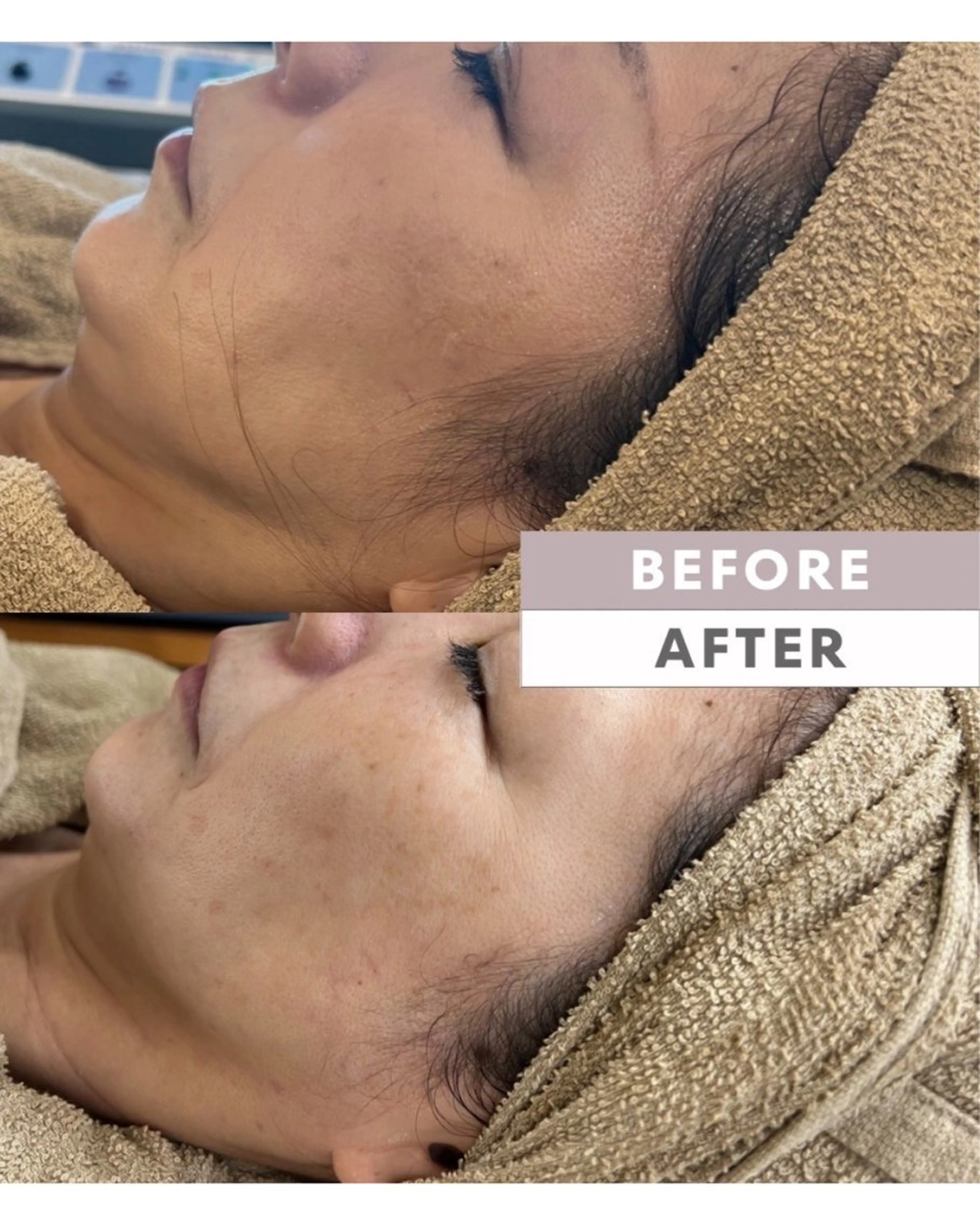 小顔形成超音波リフト60分の写真