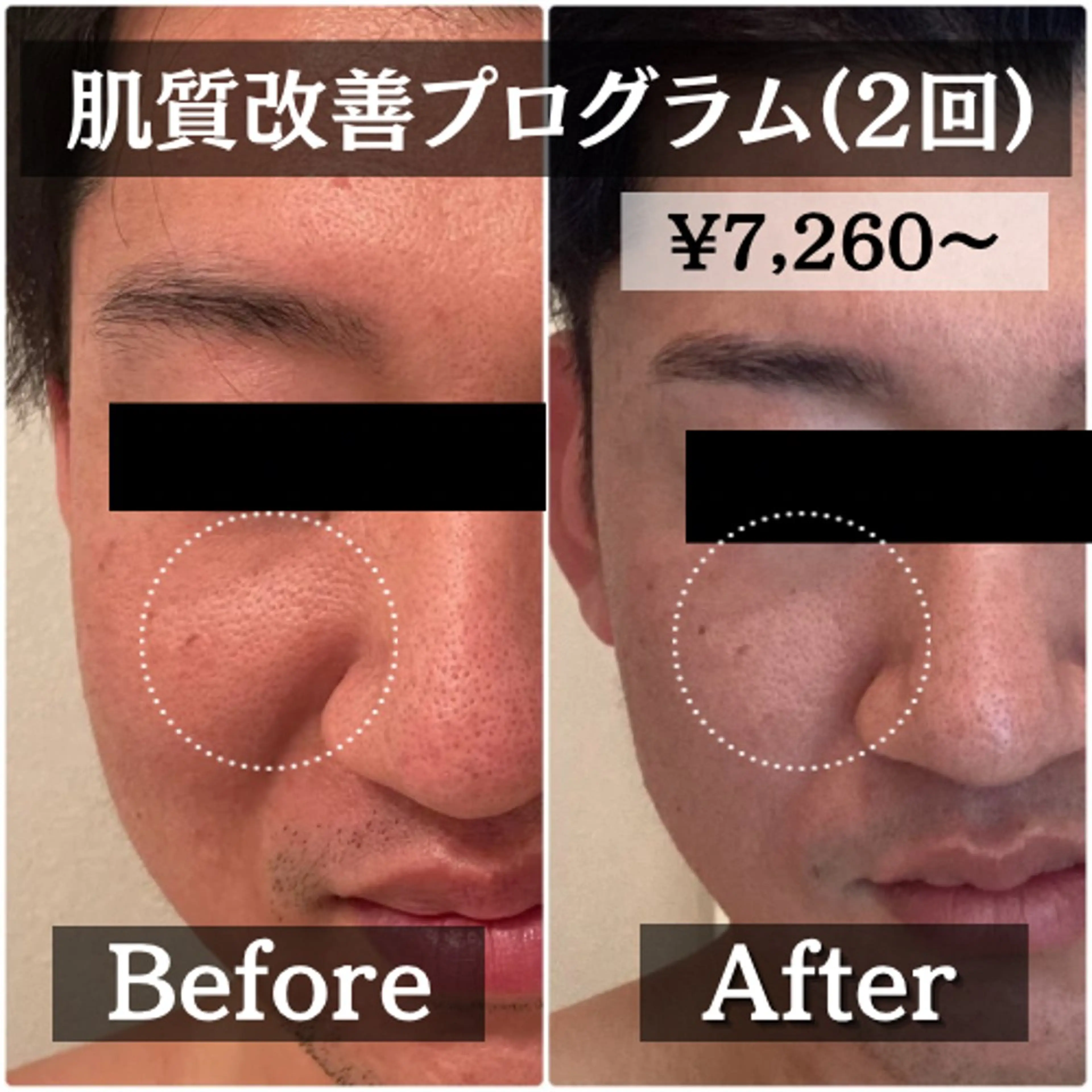 【肌質改善プログラム2回セット】トライアル化粧品一式プレゼント付♪90分¥33550→¥21340の写真