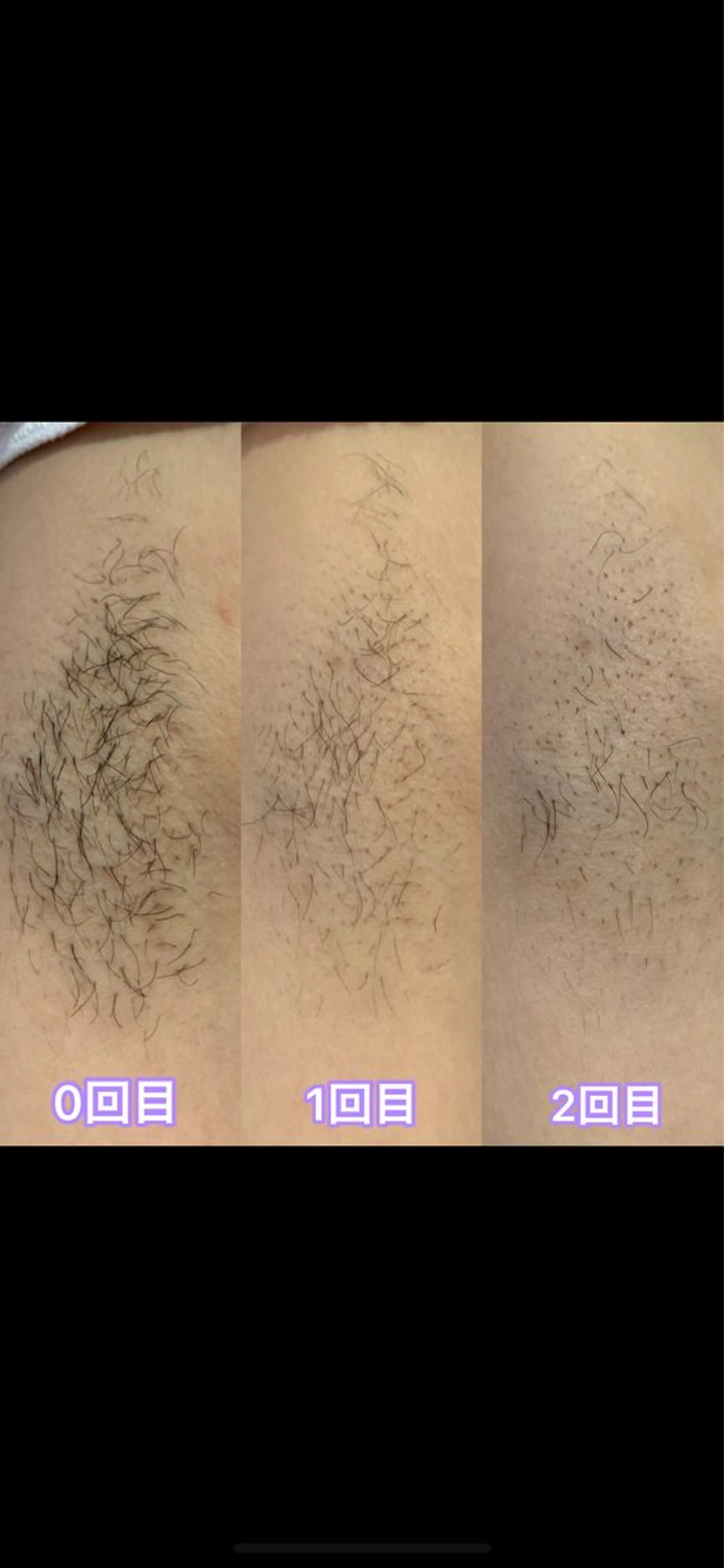 最速実感⭐︎全身脱毛【乗り換え割有・敏感肌OK🫧】の写真