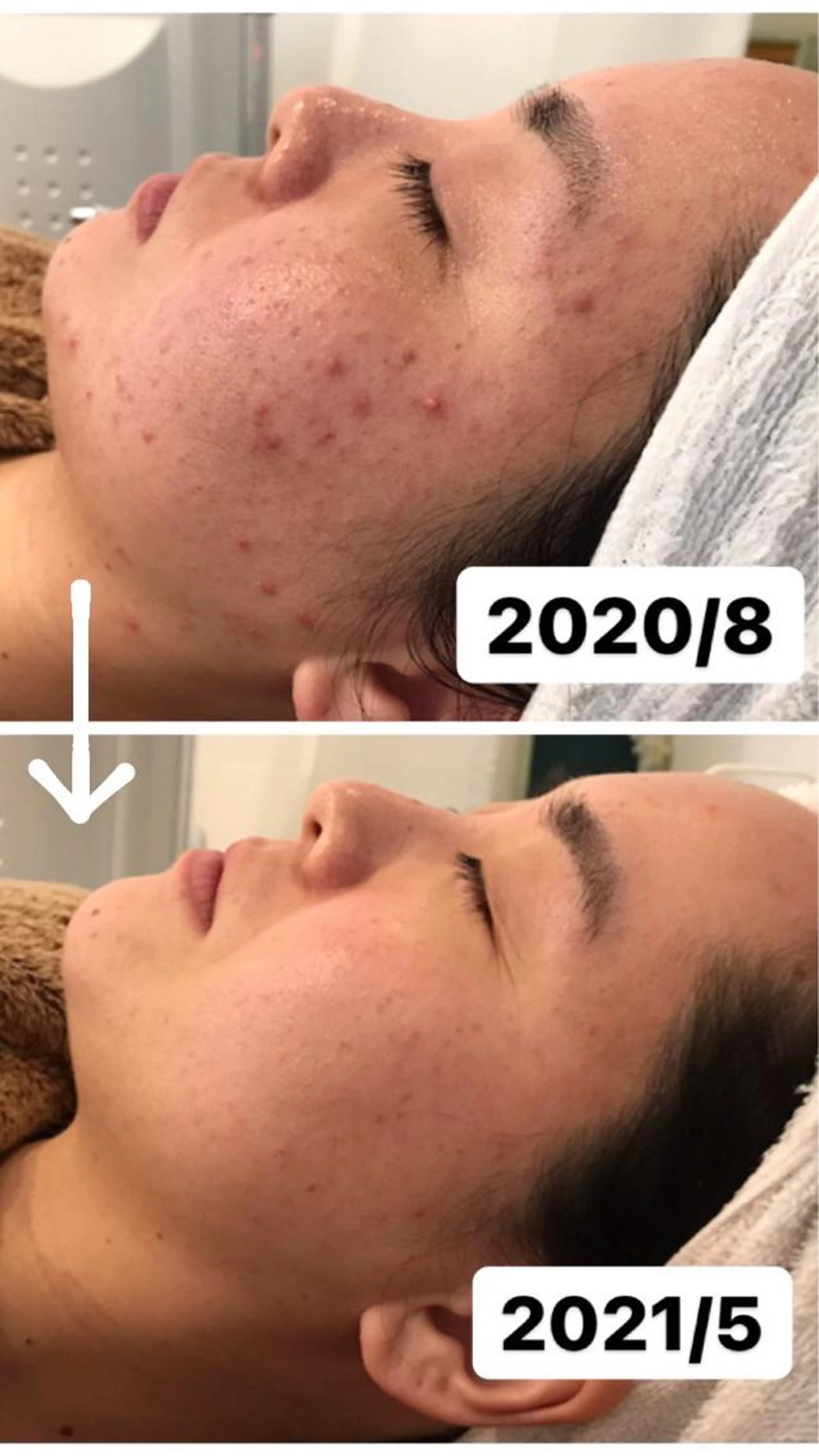 マスク😷汗💦かぶれ、ニキビ.肌荒れ対策（マスク、花粉、弱肌）の写真