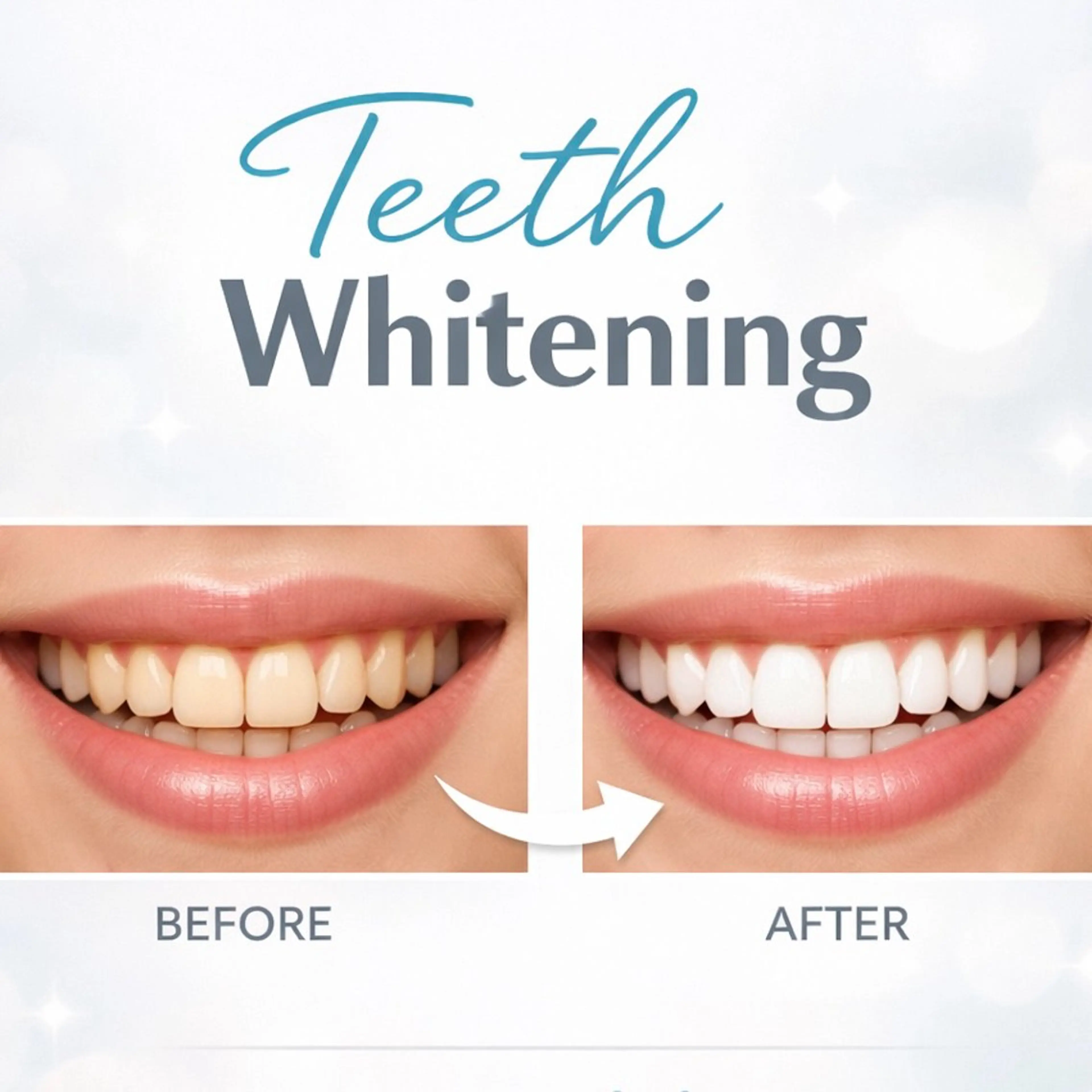 🦷【お得】セルフホワイトニング5回コース✨《しっかり白く》¥12,000の写真