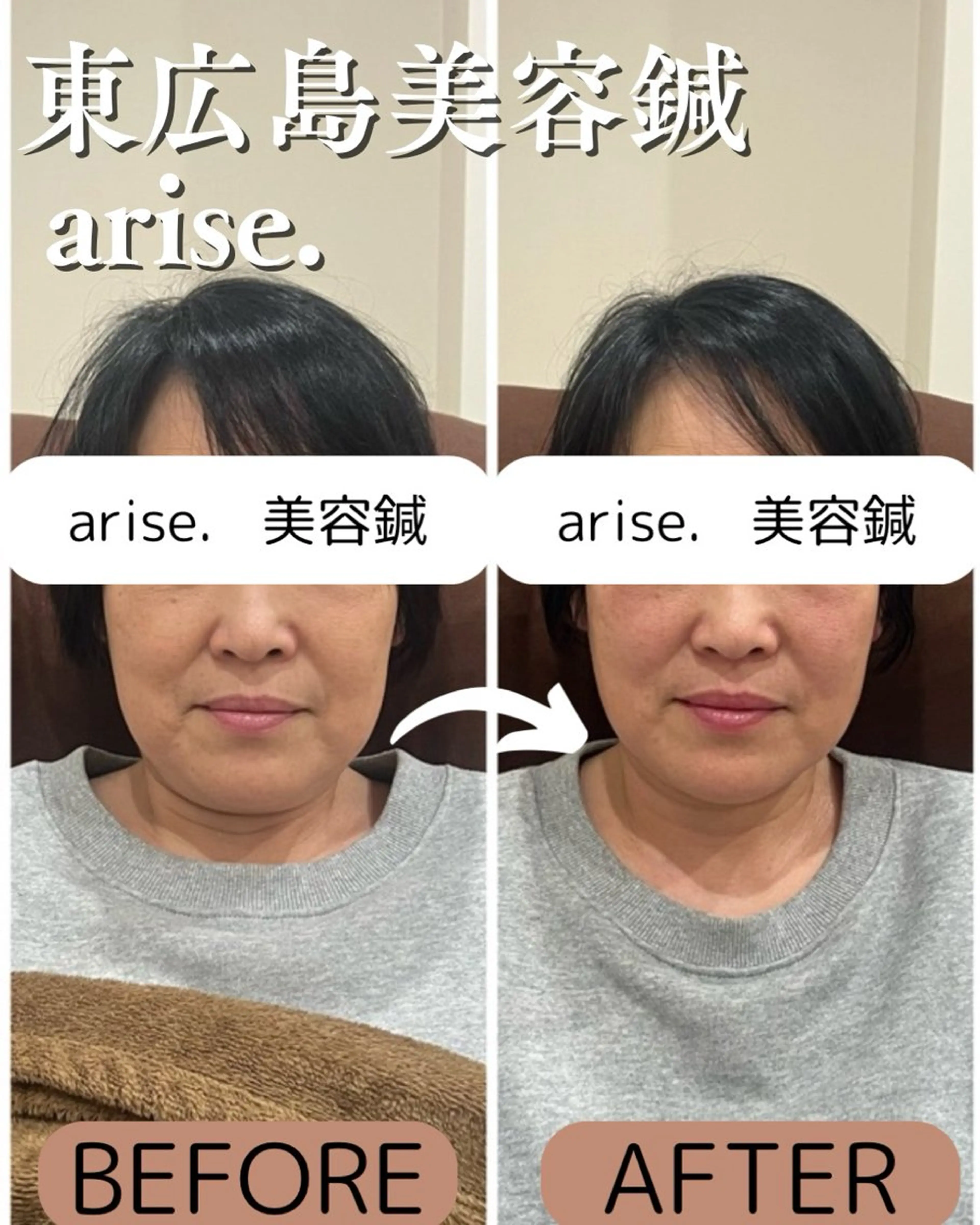その他 arise.所属・東広島美容鍼 /arise.のその他イメージ