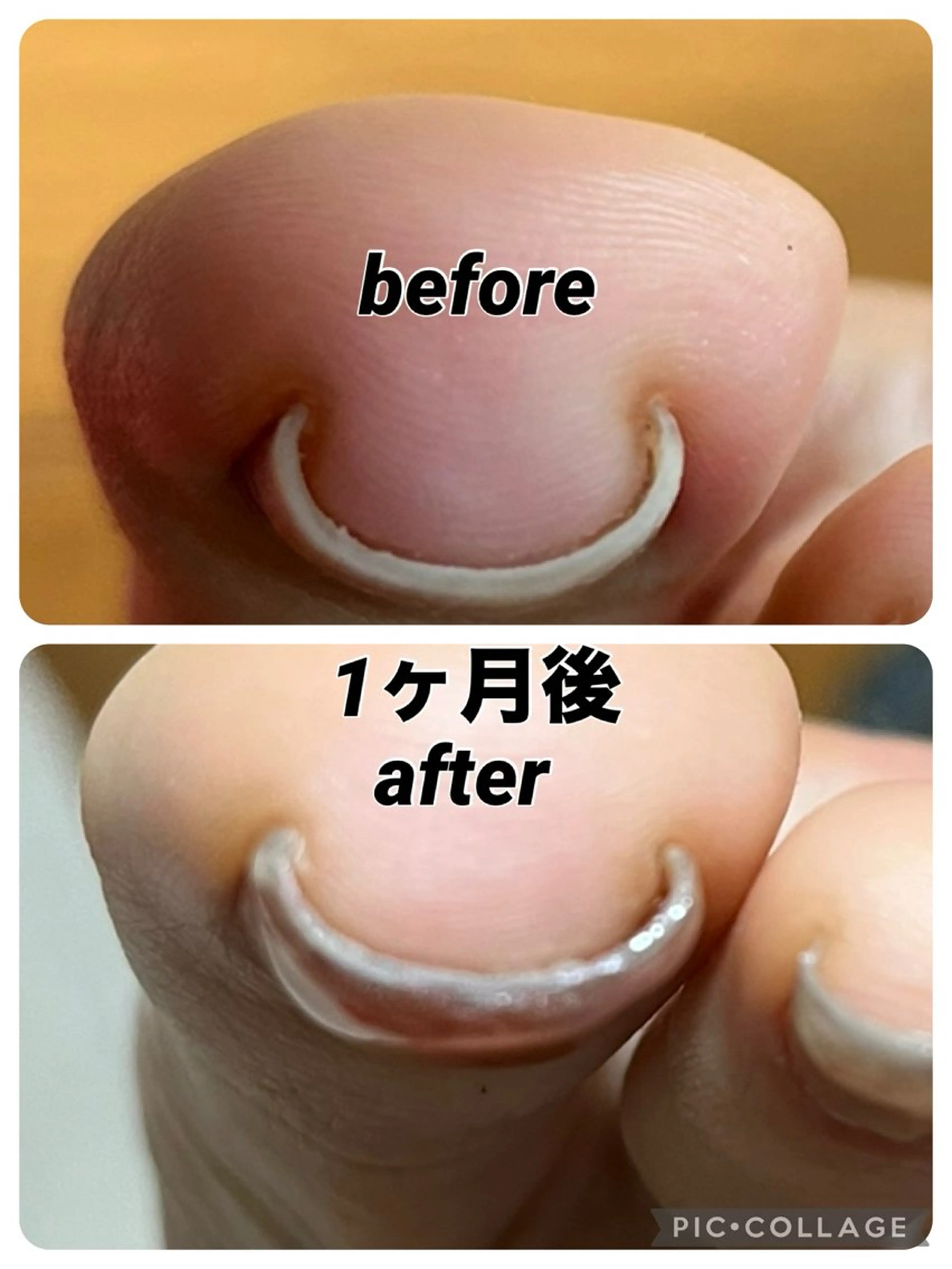 巻き爪ジェル一本の写真