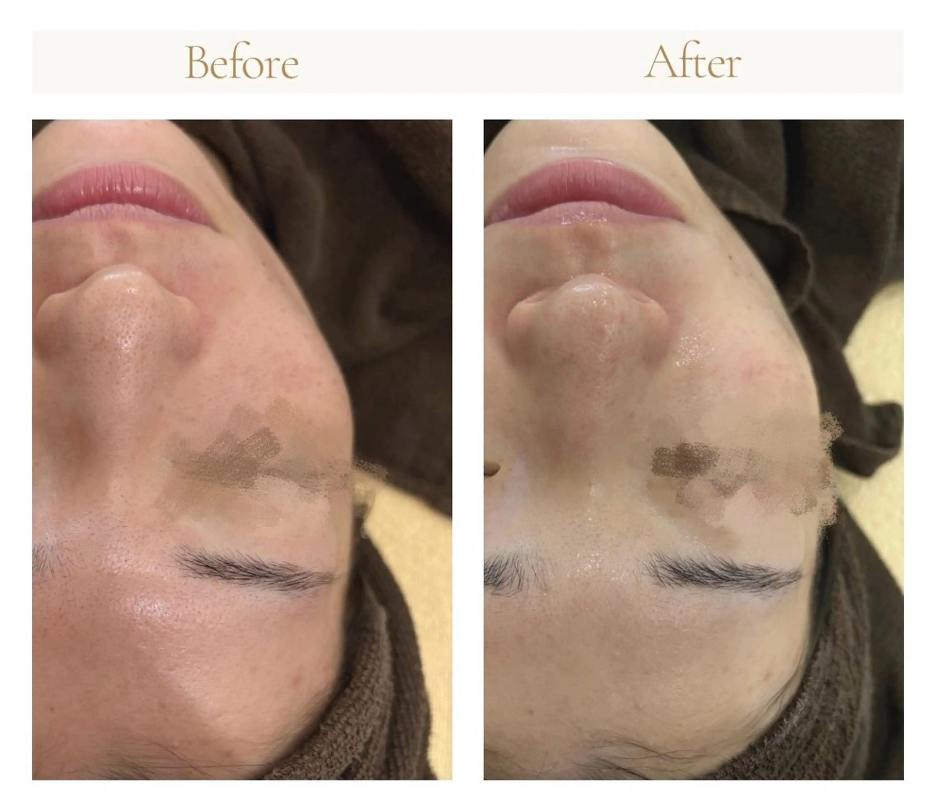 【部分ケア】気になる2ヶ所集中！選べる2パーツ毛穴洗浄（鼻＋顎/鼻＋頬/頬＋おでこなどの部位自由！）の写真