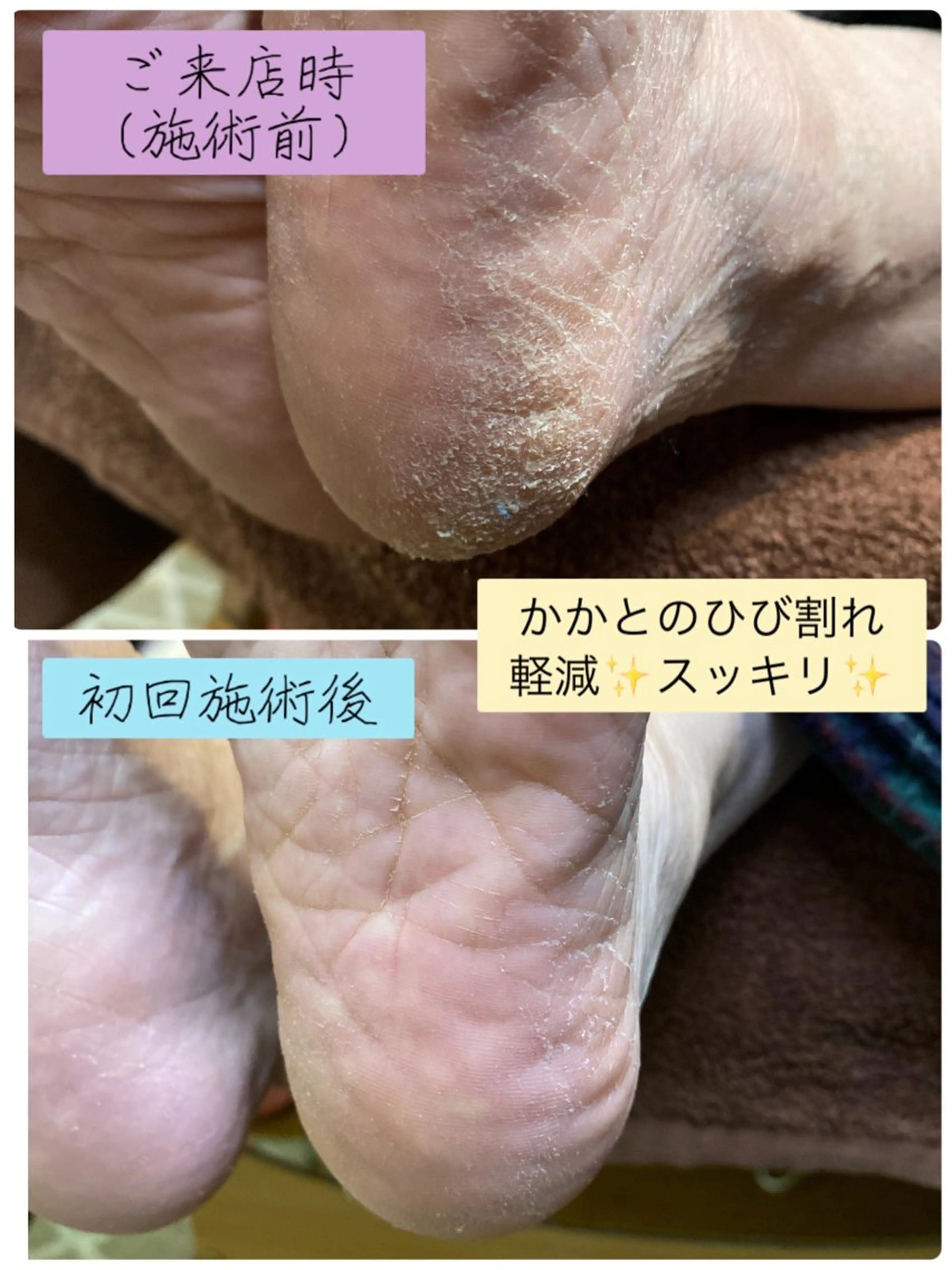 【モニター特別クーポン】◆足裏トラブル（中​〜​重度）◆タコ/魚の目/角質【トラブルケア】の写真