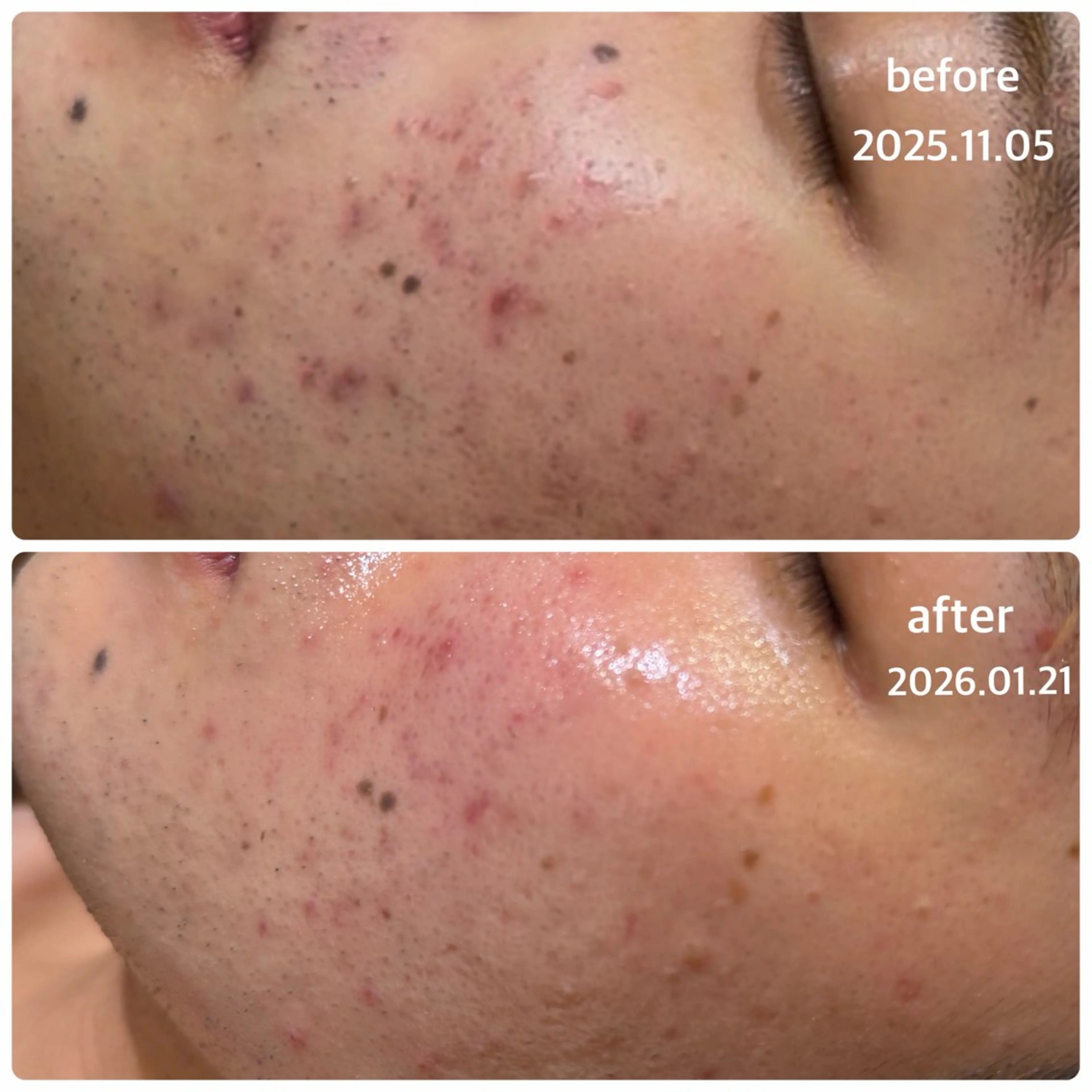 【メンズエステ】限定！《エンザイムパウダー追加》毛穴・くすみケアに特化！！ターンオーバー促進透明感のあるお肌への写真