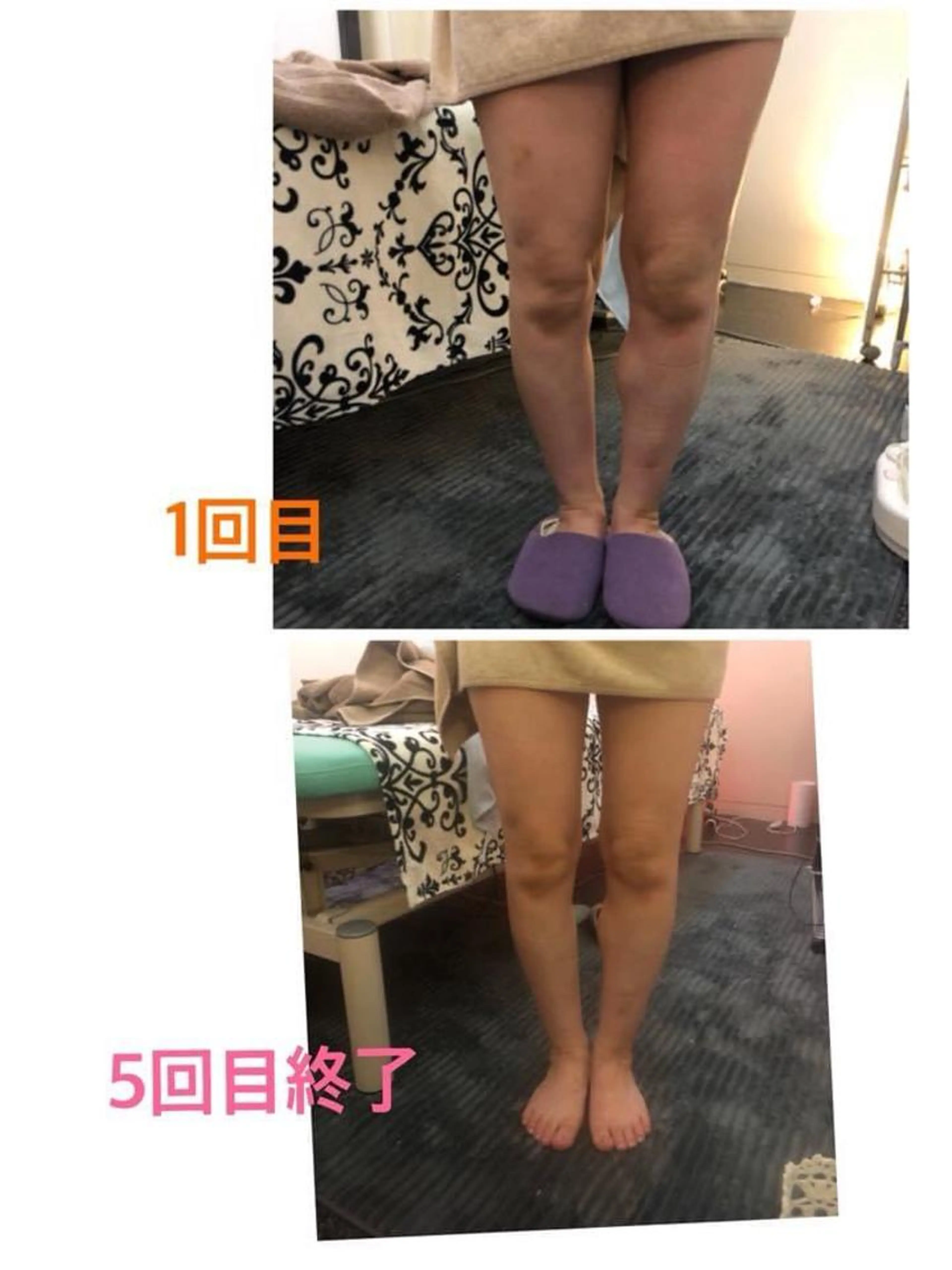 ミラクルウェーブ（脚）＋コラーゲンマシン40分の写真