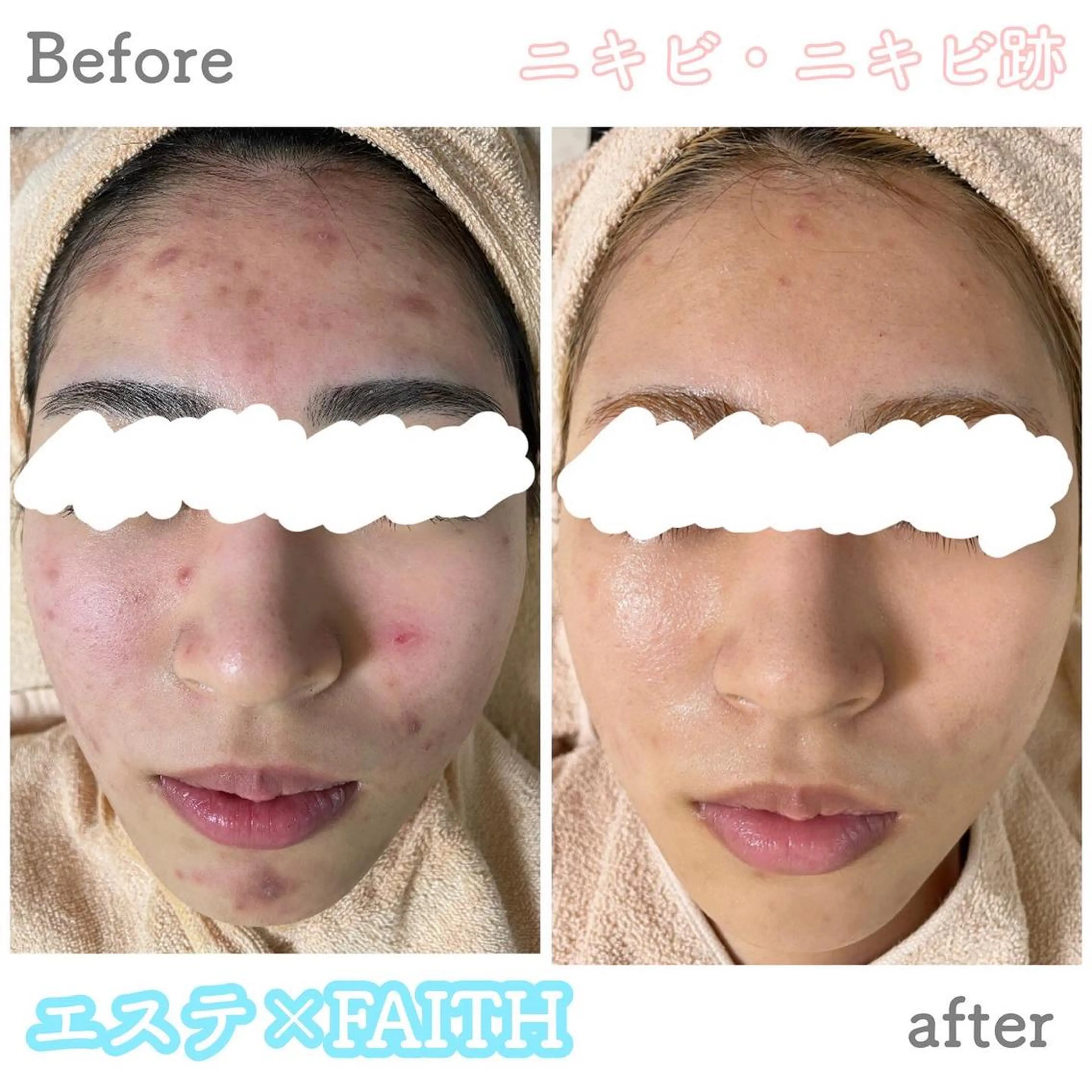 《メニューに迷われてる方》お肌を見させて頂いてから最適なコースをご案内致します😽🫧の写真