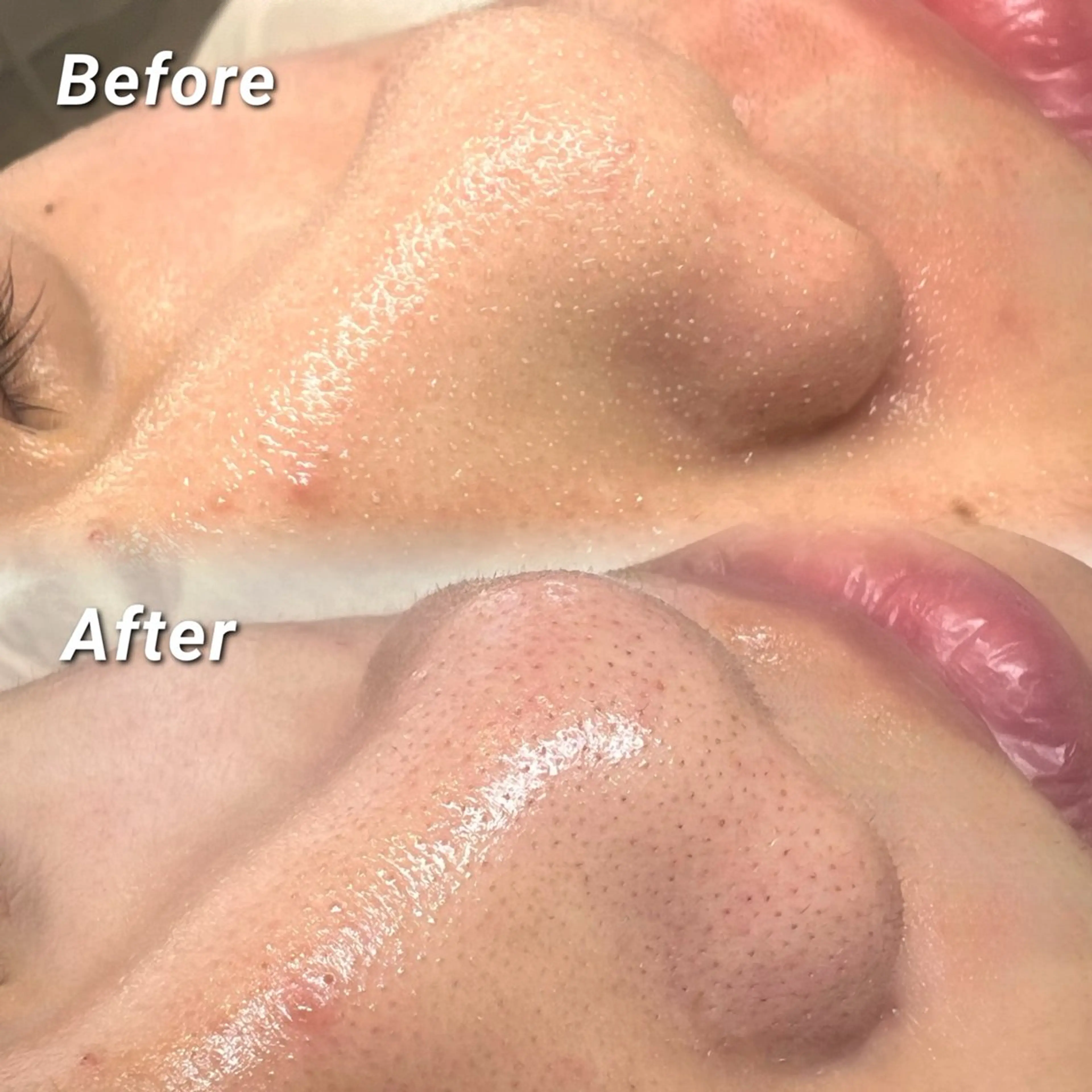 🐬ミニモ特別価格🐬【毛穴洗浄】ハイドロピーリング¥12,000→¥5,000の写真