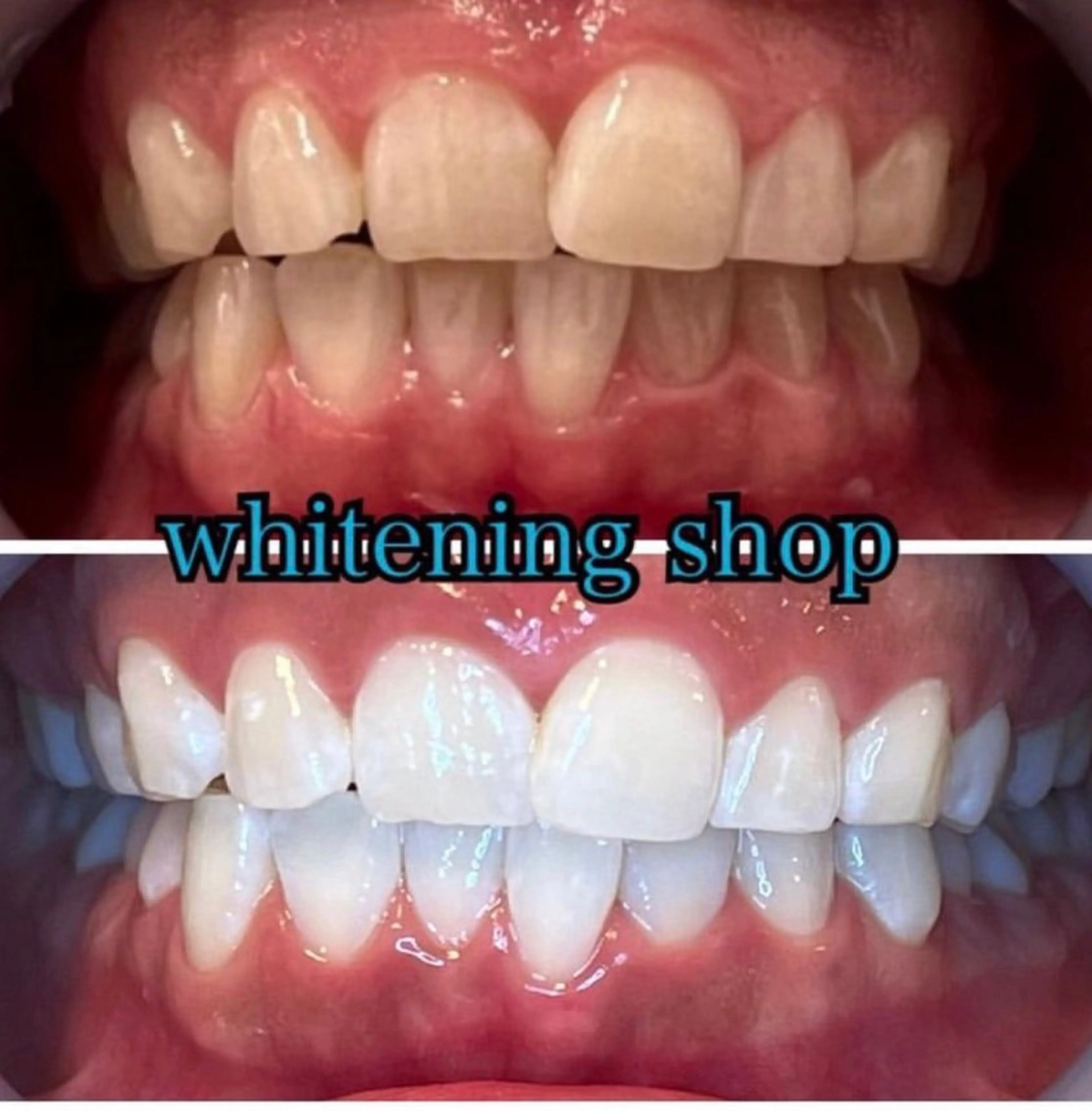 【当店1番人気✨フリーパス】セルフホワイトニング20分×20回コース🦷（20分照射1回あたり1650円でお得❤️）の写真