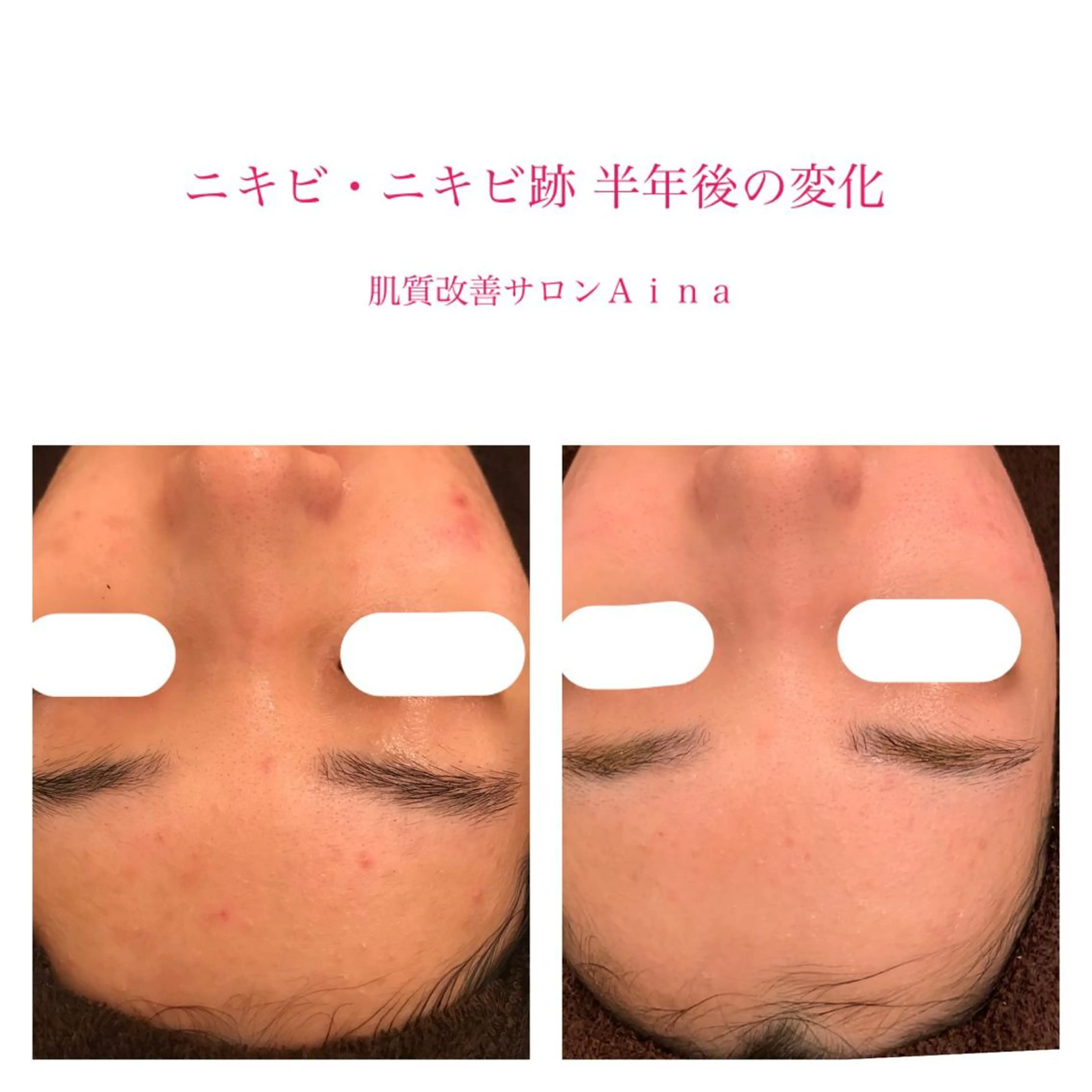 ロング カラー パーマ キッズ ネイル マツエク・マツパ 卒業式のヘアスタイル 学生 卒業式 赤色 エステ リラク ニキビ跡専門サロン Ａｉｎａのエステ・リラクイメージ