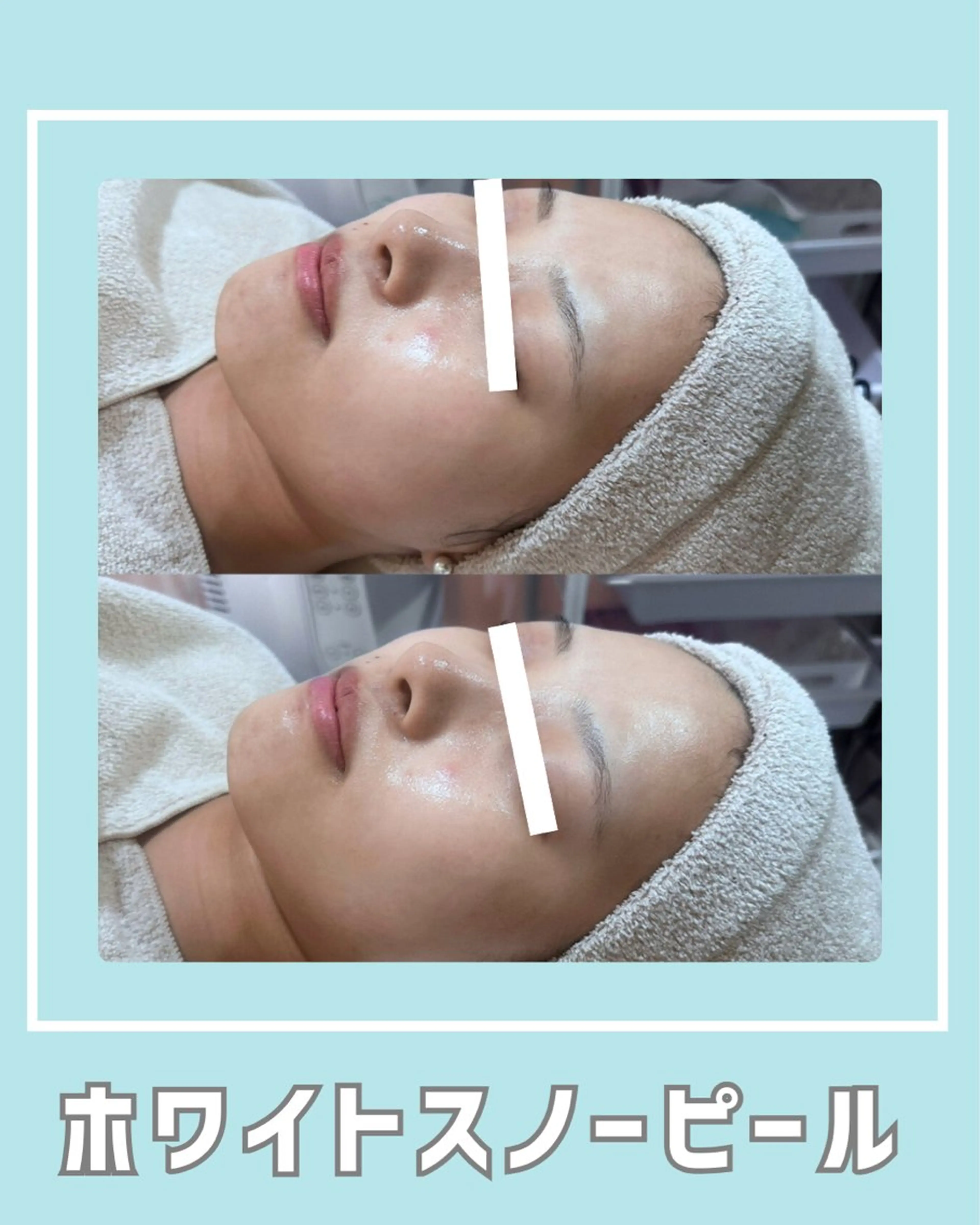 エステ |ピーリング・毛穴| soina神楽坂のエステ・リラクイメージ