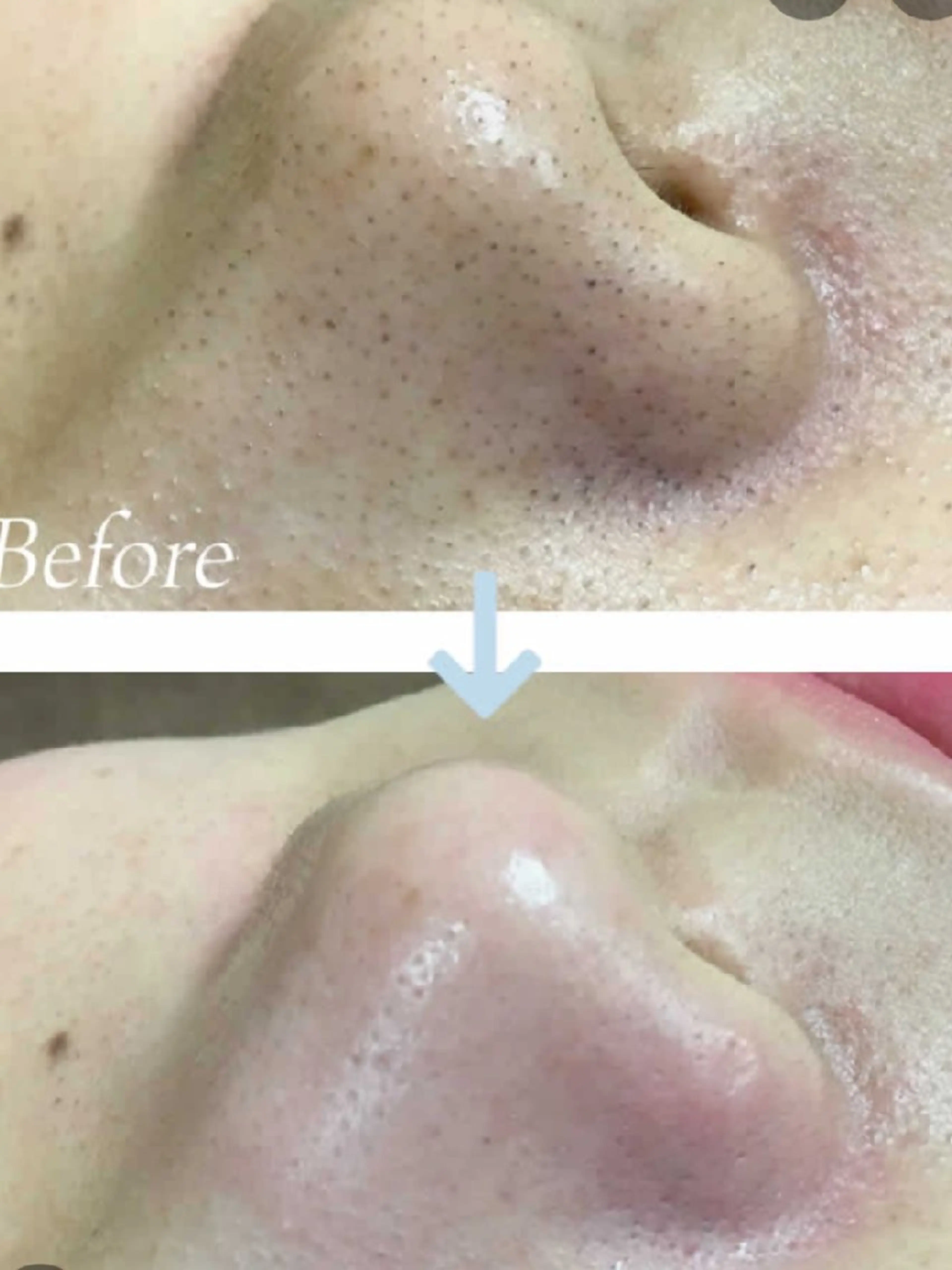 イチゴ鼻撃退、韓国式毛穴洗浄(お試し鼻プラン)の写真