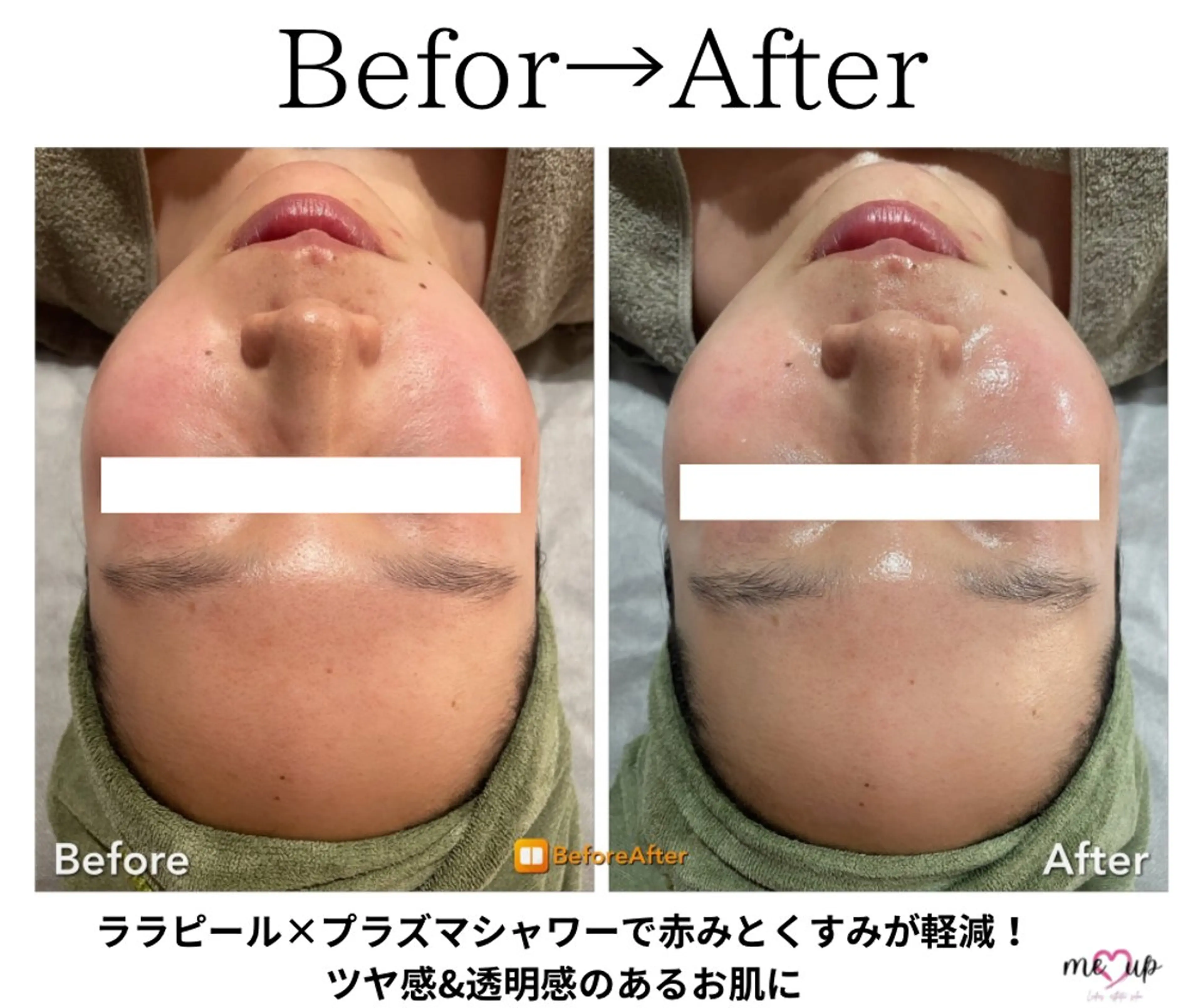 エステ Meupニキビ専門店 背中/ハーブ/肌管理のその他イメージ