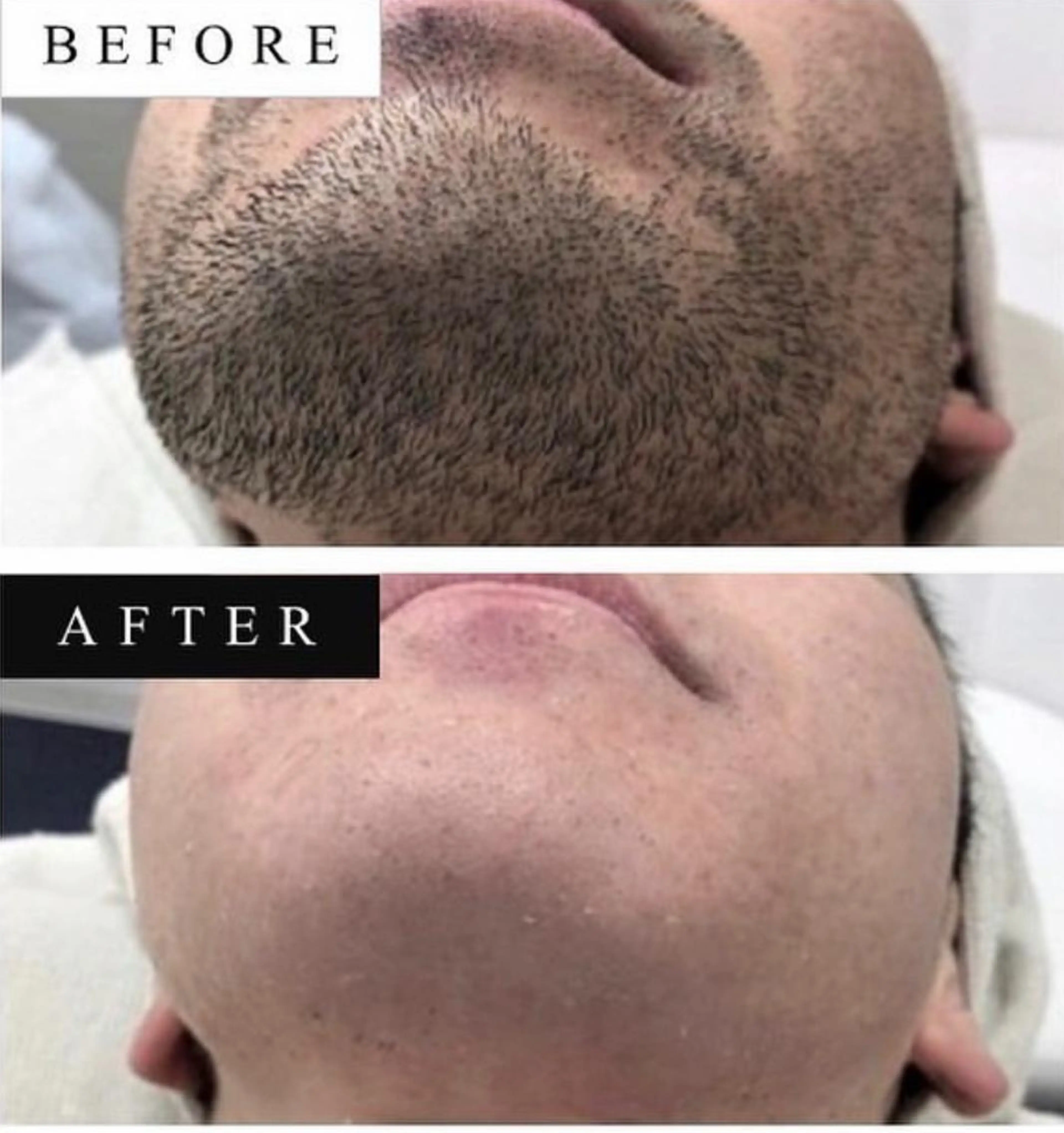 ヒゲ脱毛の写真