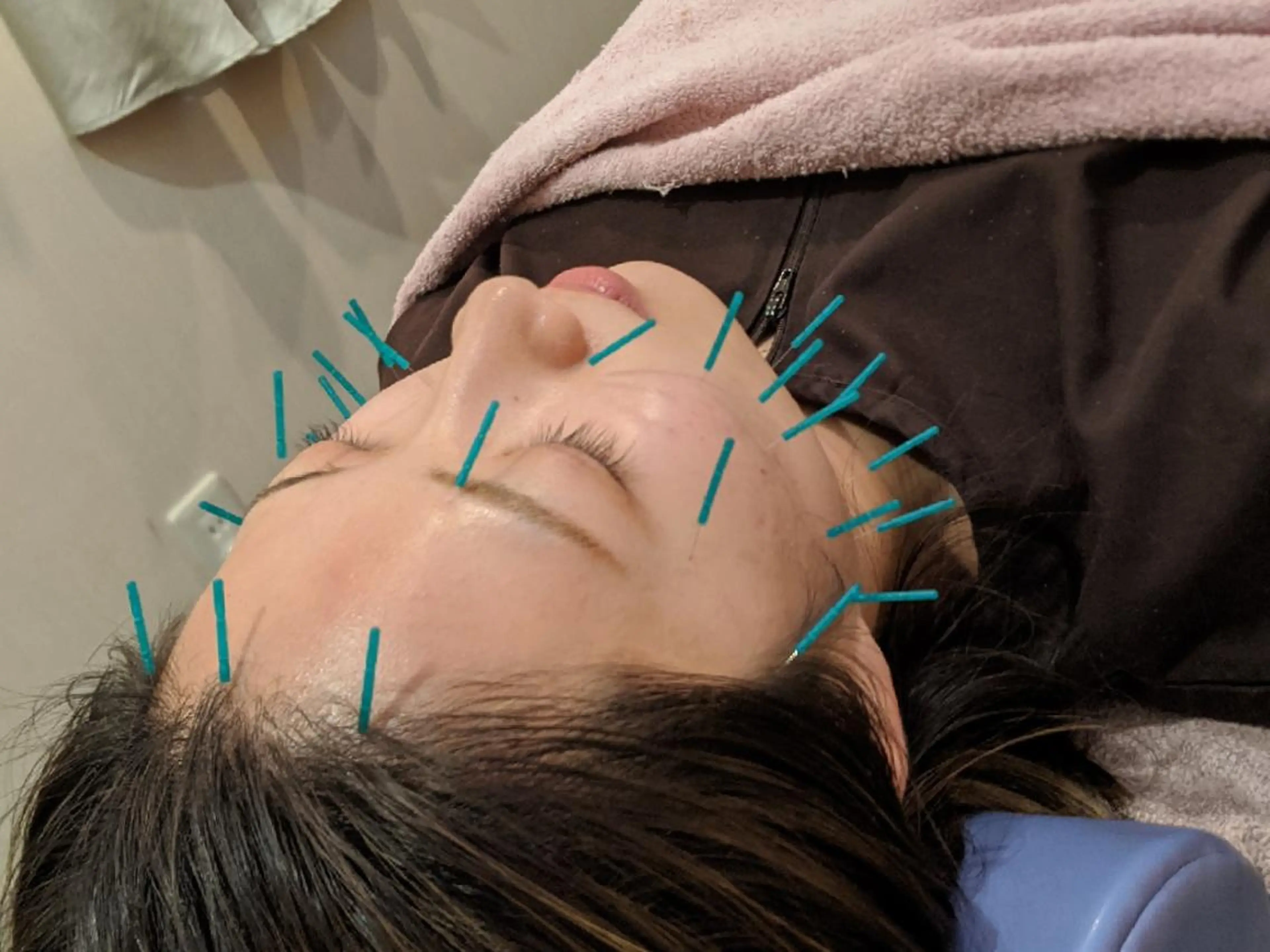 エステ リラク 乃々鍼灸・整体院　表参道所属・乃々鍼灸整体院　植木 　【美容鍼/整体】のエステ・リラクイメージ