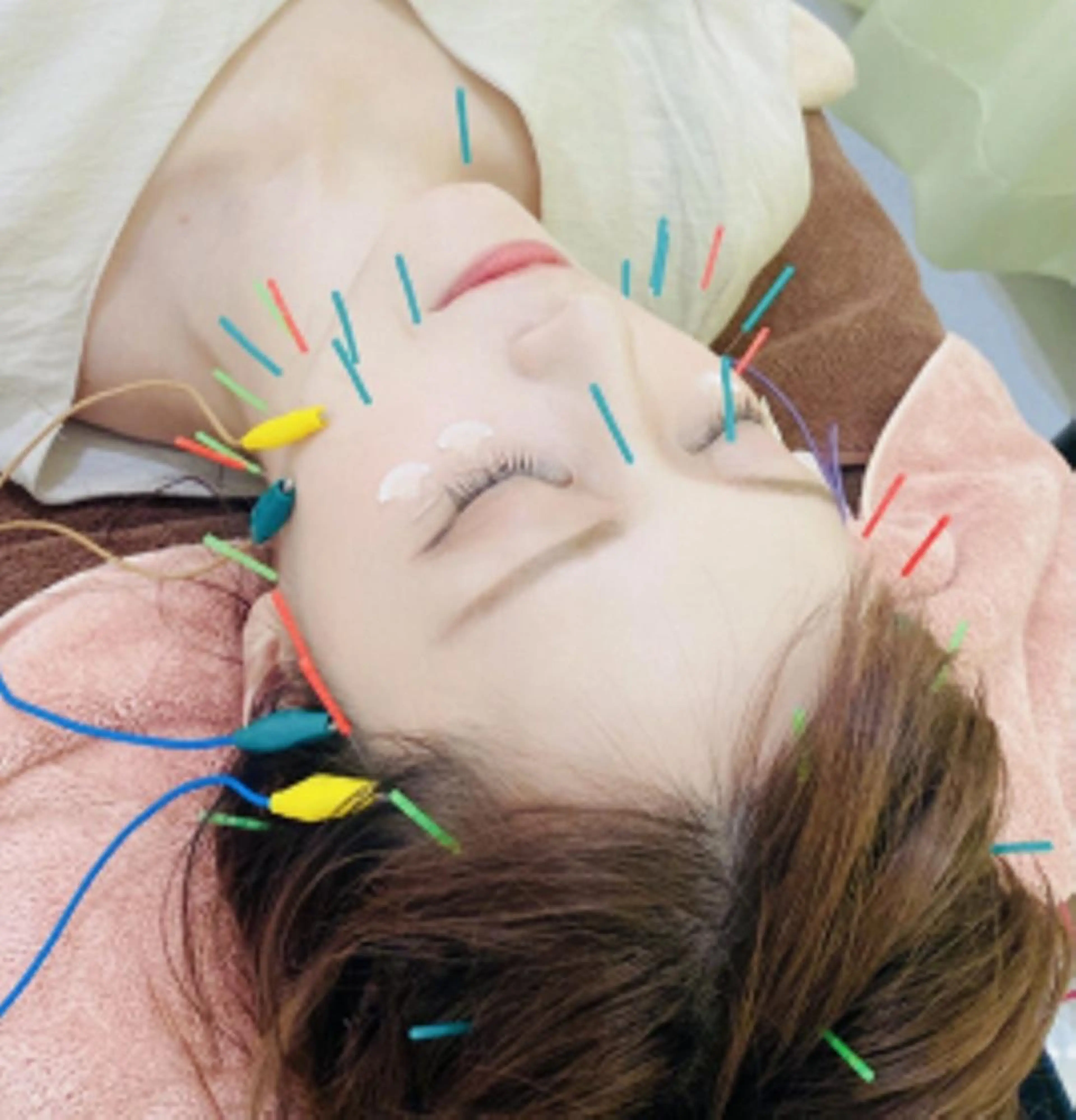 美容鍼プレミアム【電気✖︎頭皮鍼でリフトUP⤴️】の写真