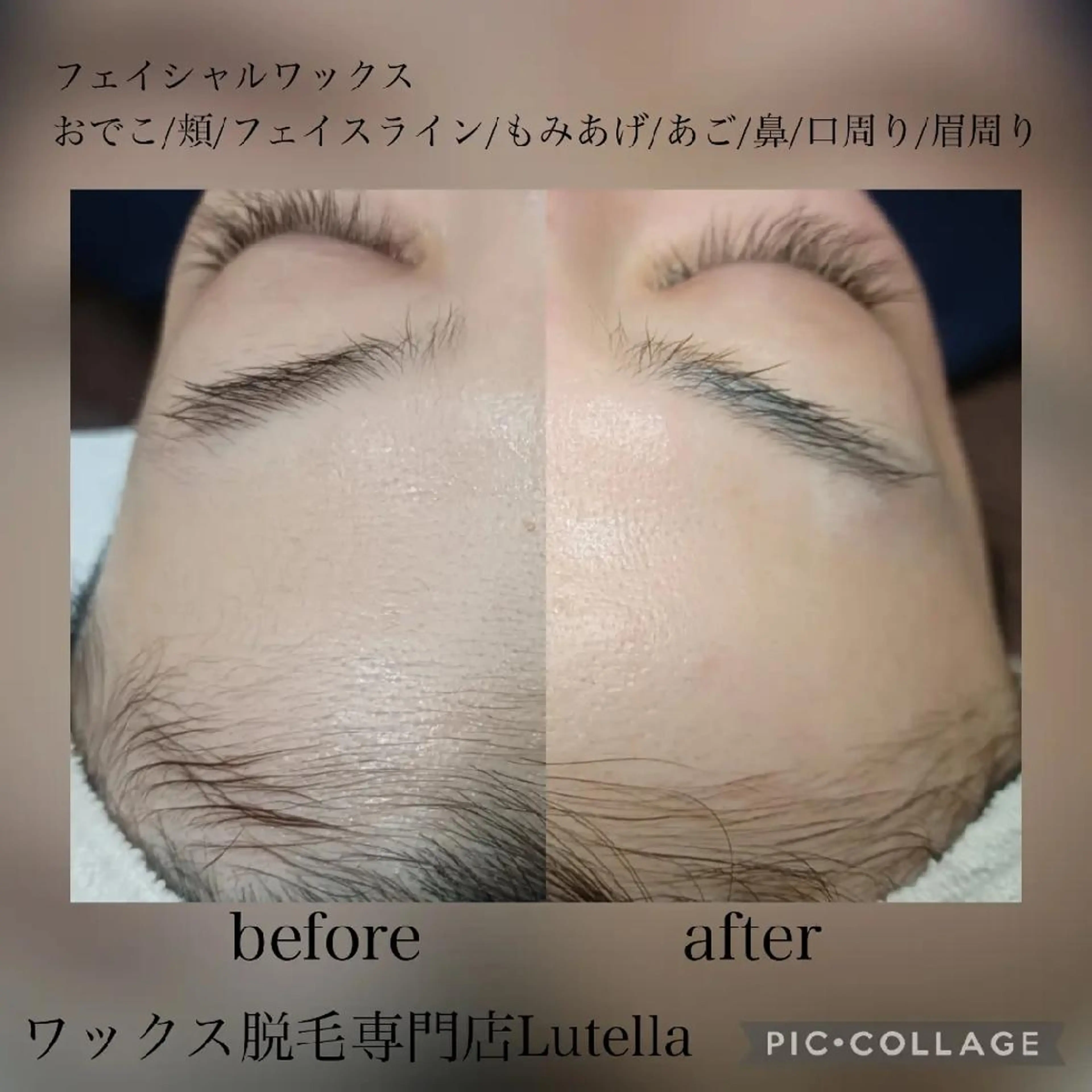 【女性】ブラジリアンワックス(VIO)+フェイシャルワックスの写真