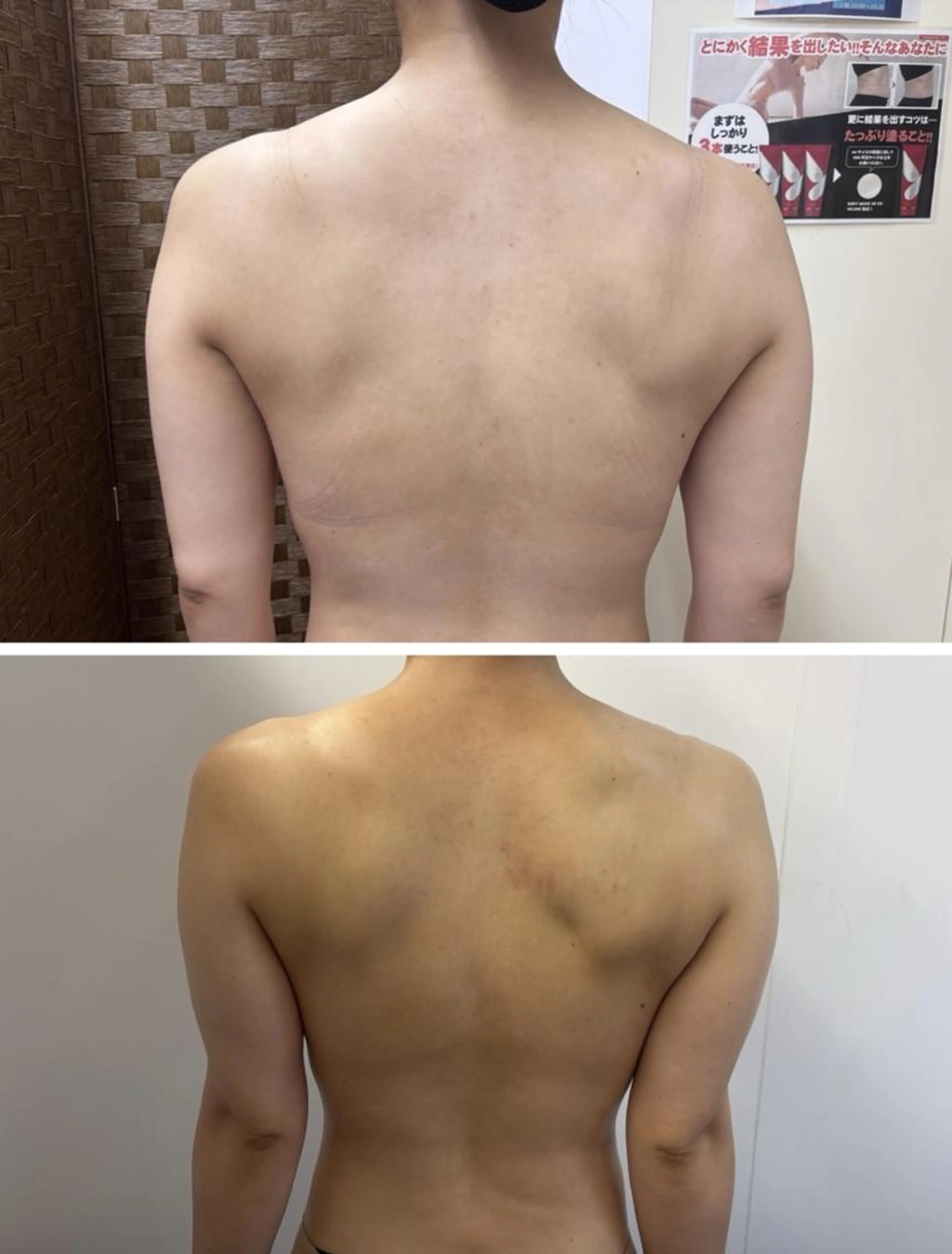 肩こりで悩まれているそこのあなた！肩こりや巻き型、姿勢のケアで綺麗なバストに導きます⭐️の写真