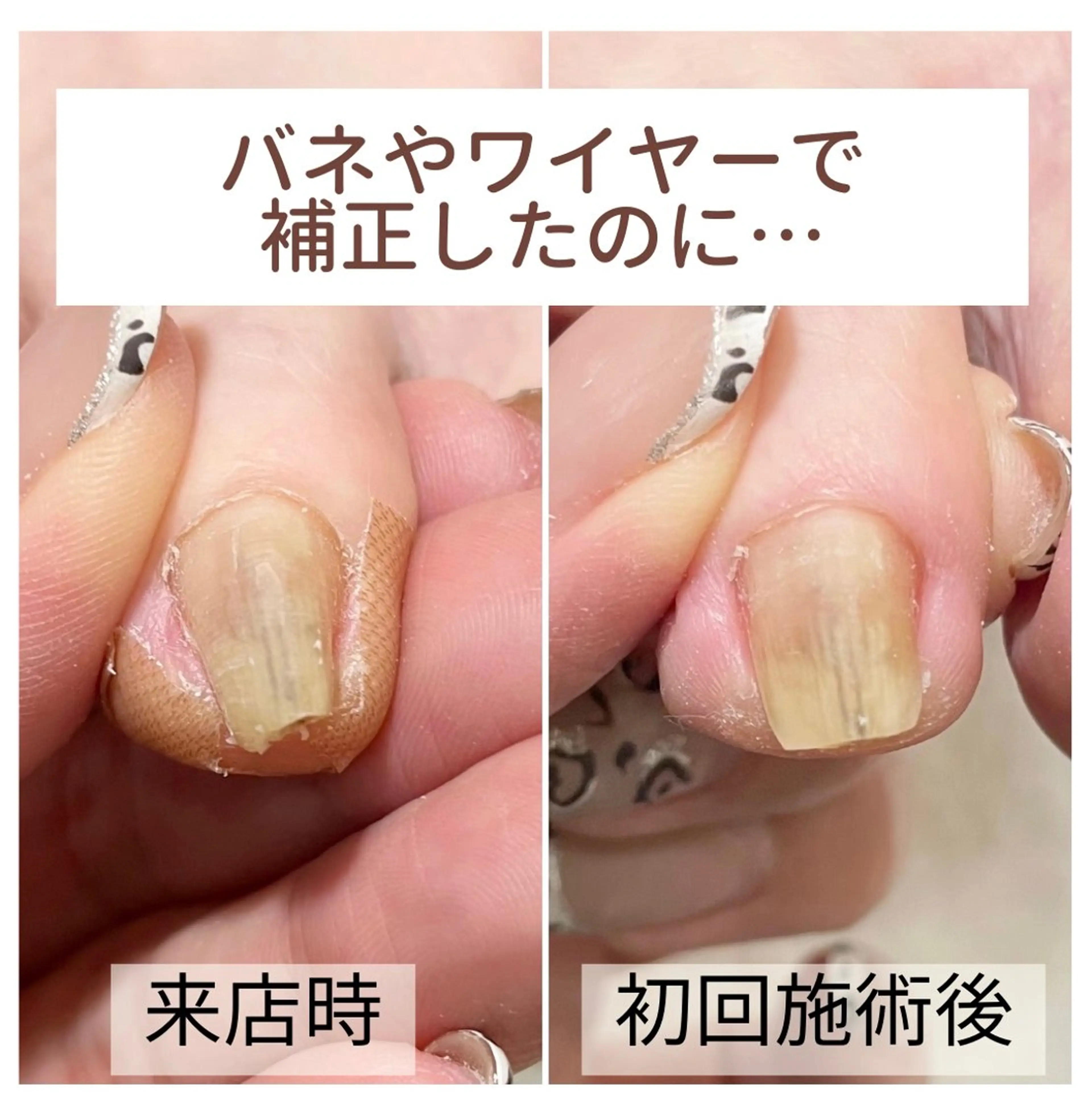 ネイル 深爪・巻き爪 専門サンセリテのネイルデザイン