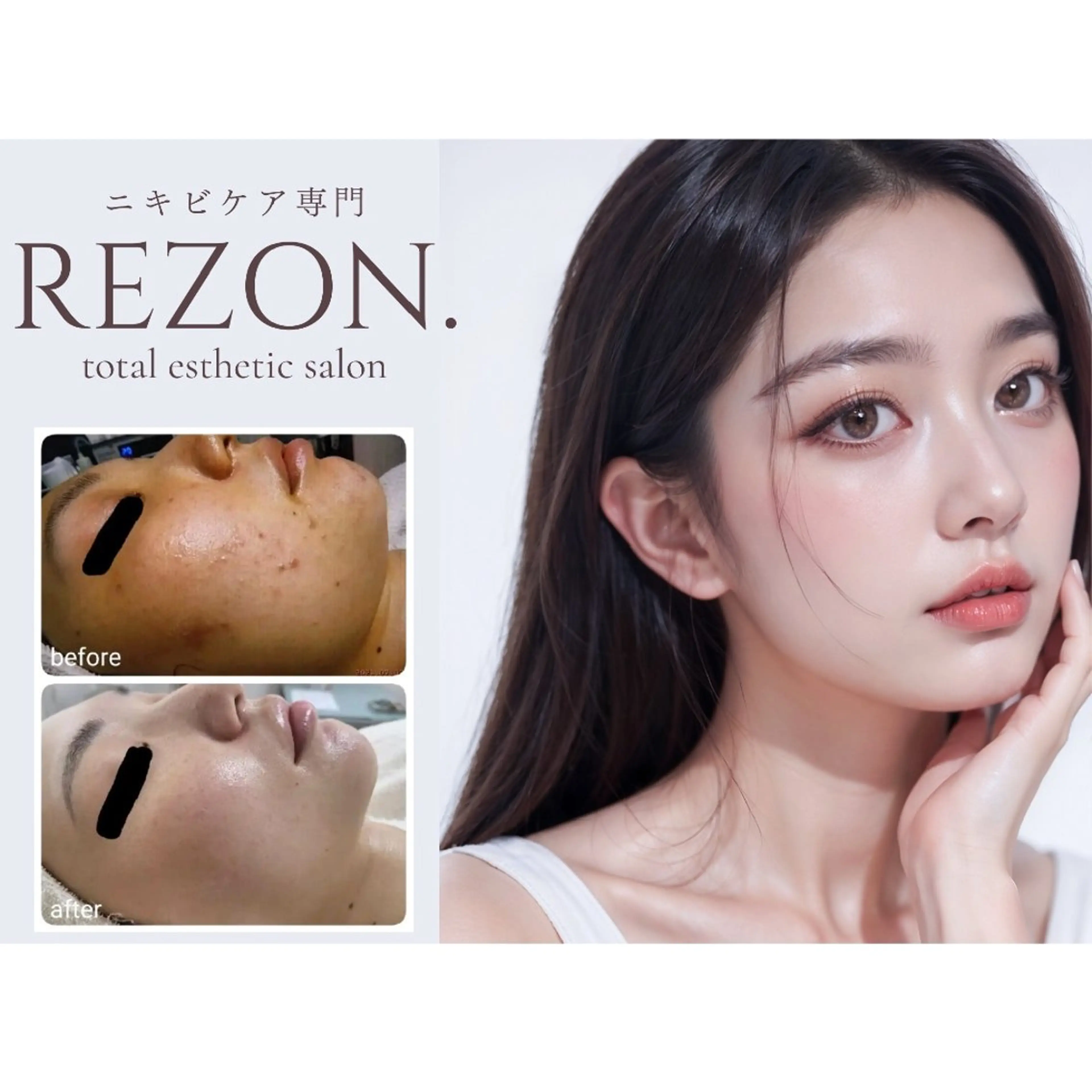 社会人応援🈹リピ率90%‼️【体験2回5000円】皮膚科でも治らないニキビ・ニキビ跡を無かったことに［京橋駅］の写真