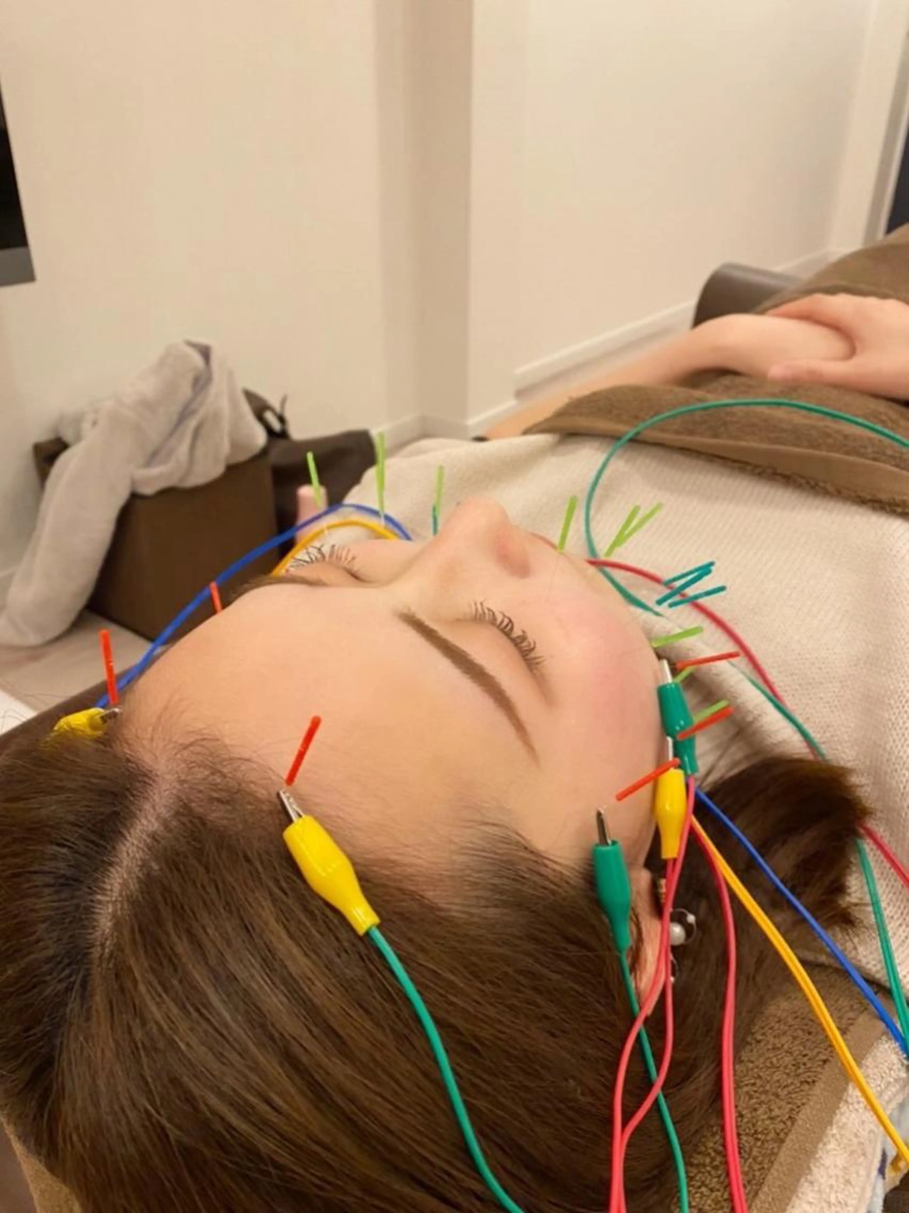 ⭐️美容鍼（くま ニキビ　毛穴　はり　つや　たるみ　ほうれい線）⭐️の写真