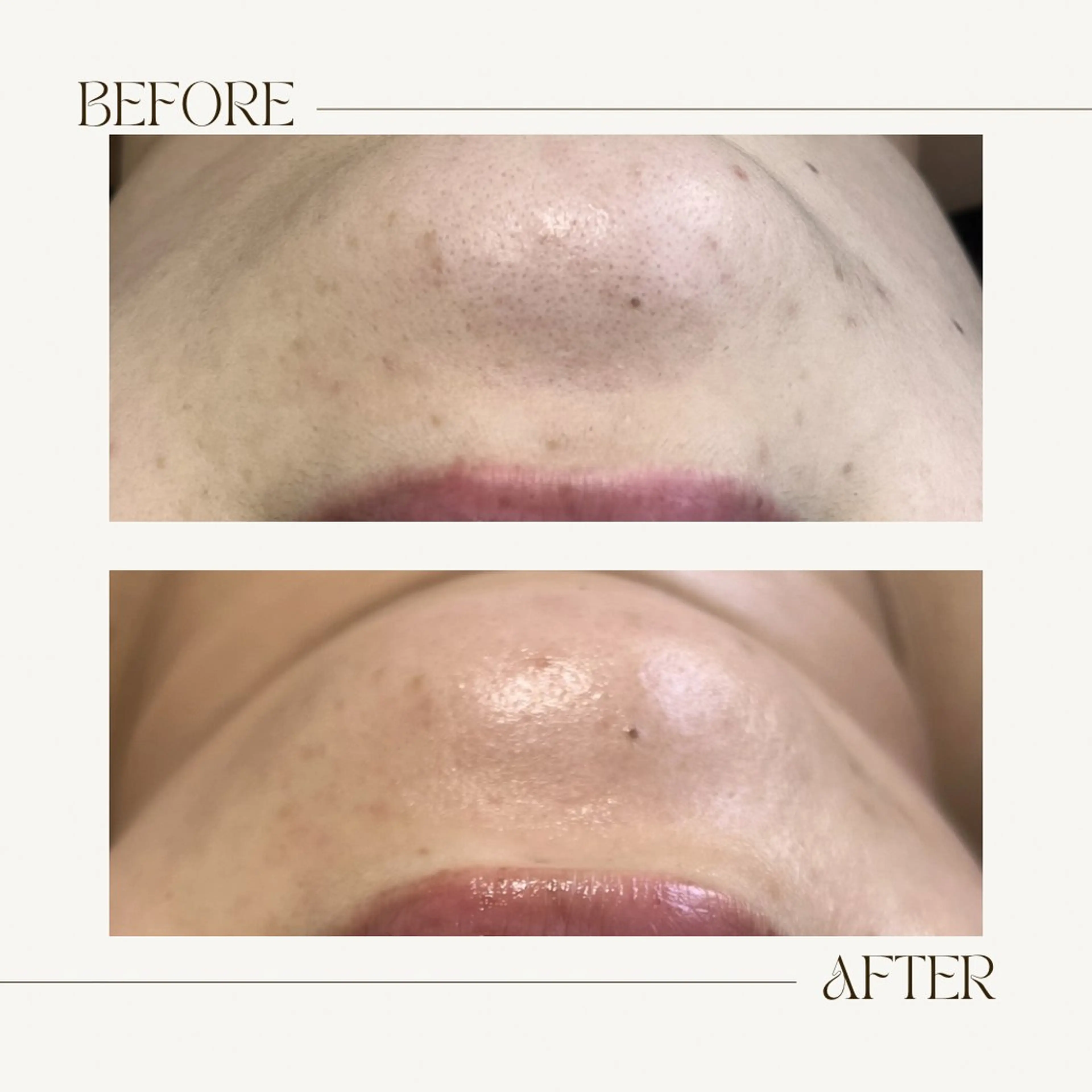 脱毛 1st｜フェイシャル エステ専門店のエステ・リラクイメージ