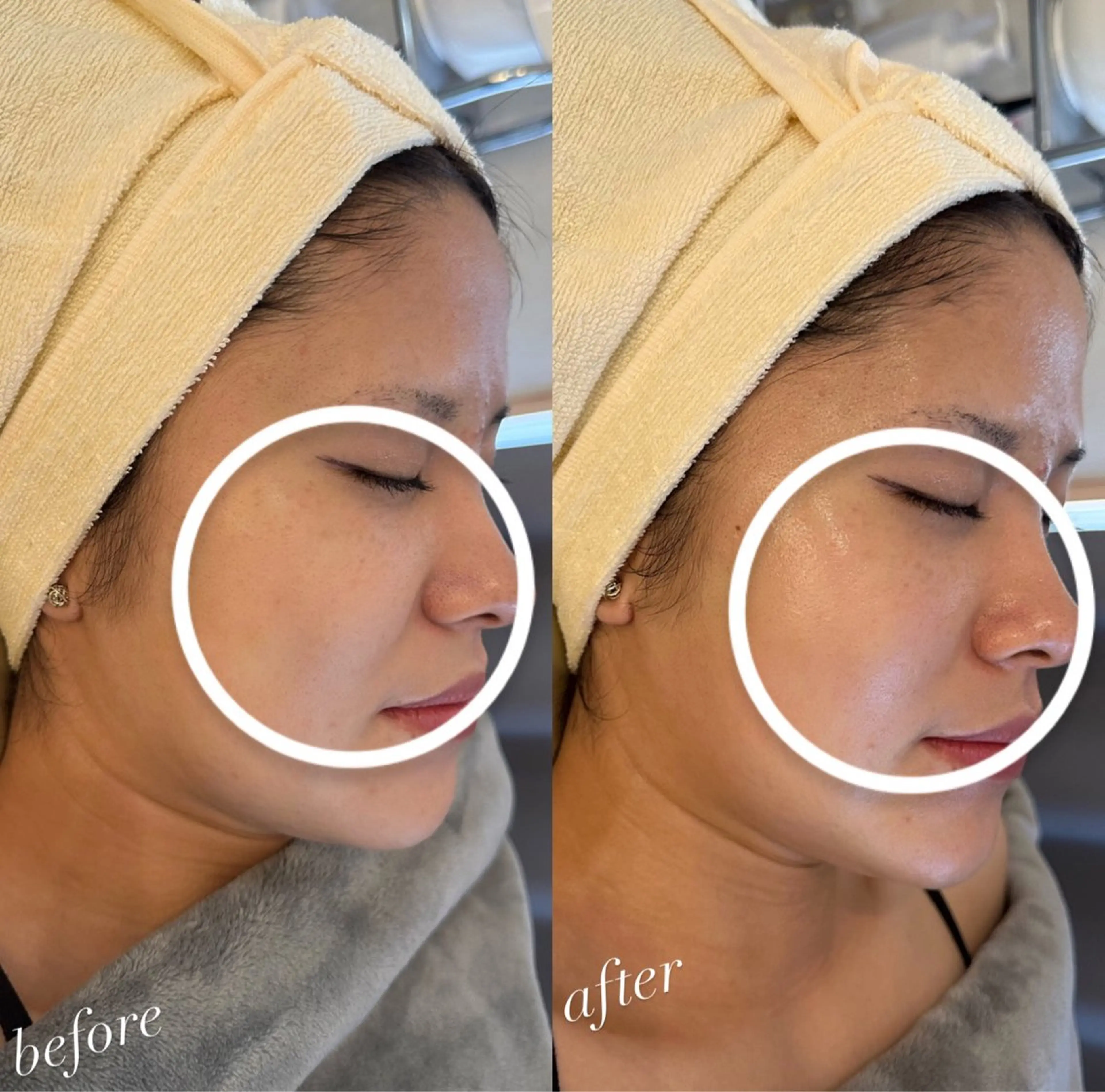 『フェイシャル 毛穴の汚れ‪✕‬リフトアップコース💝𖤐´-』毛穴ケアにリフトアップ効果◎ #毛穴 #リフトアップの写真