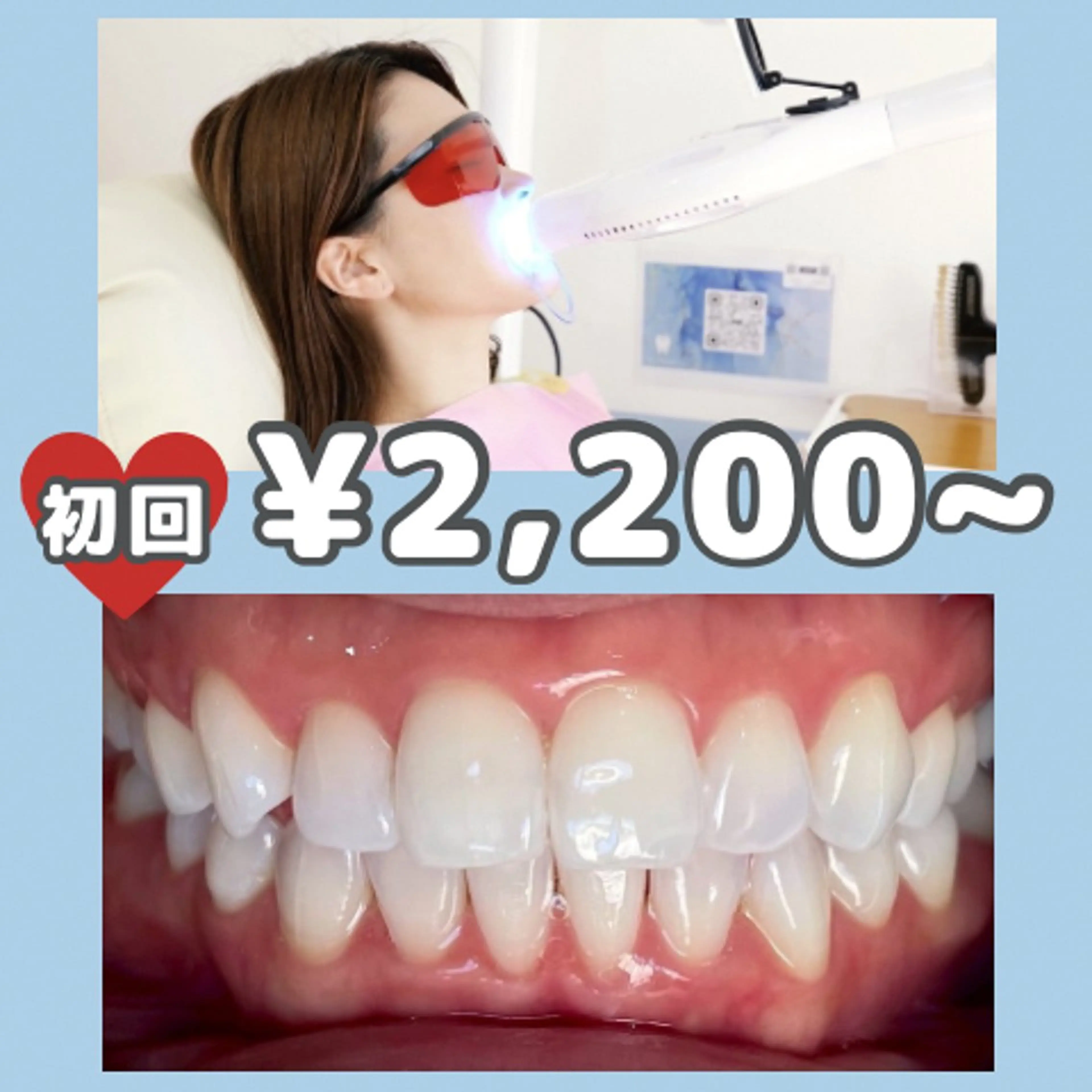 その他 サクッとホワイト都立大学店所属・セルフホワイトニング 都立大学🦷✴︎のその他イメージ