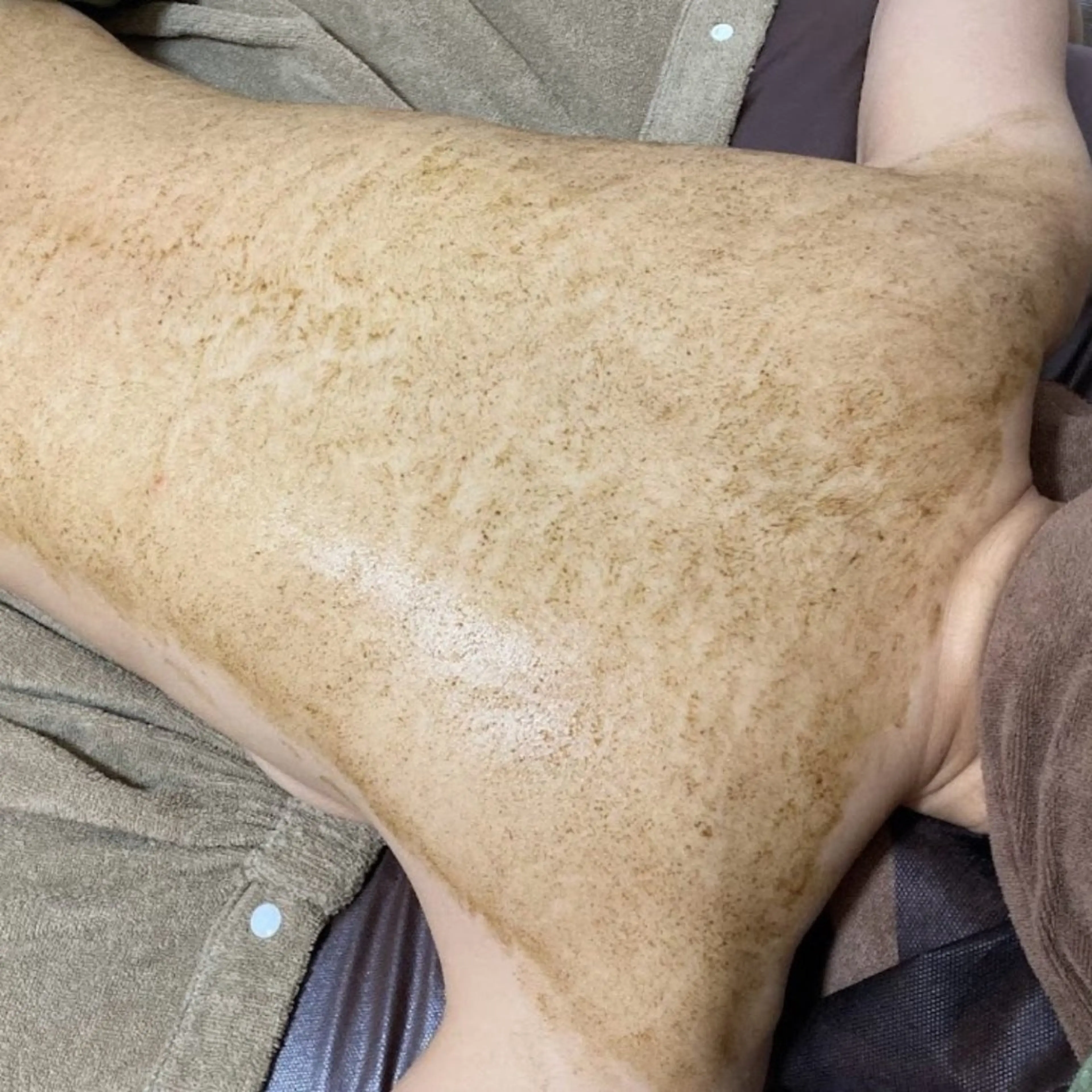 初回【ニキビケア】背中全体ハーブピーリング★40分の写真