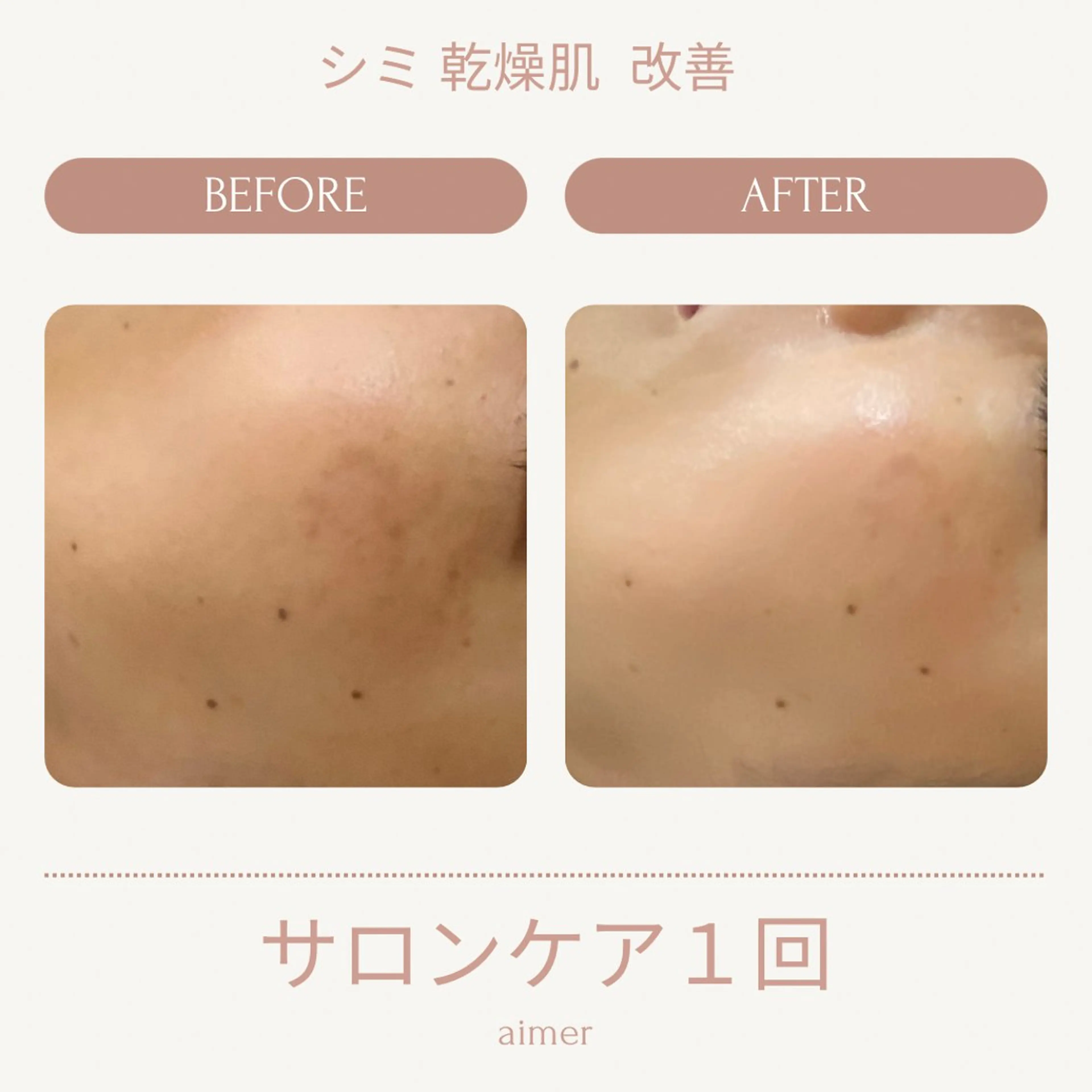 透明感が欲しい方におすすめ！“細胞活性機械“セルサー美白コース＊女性限定＊マッサージつきの写真