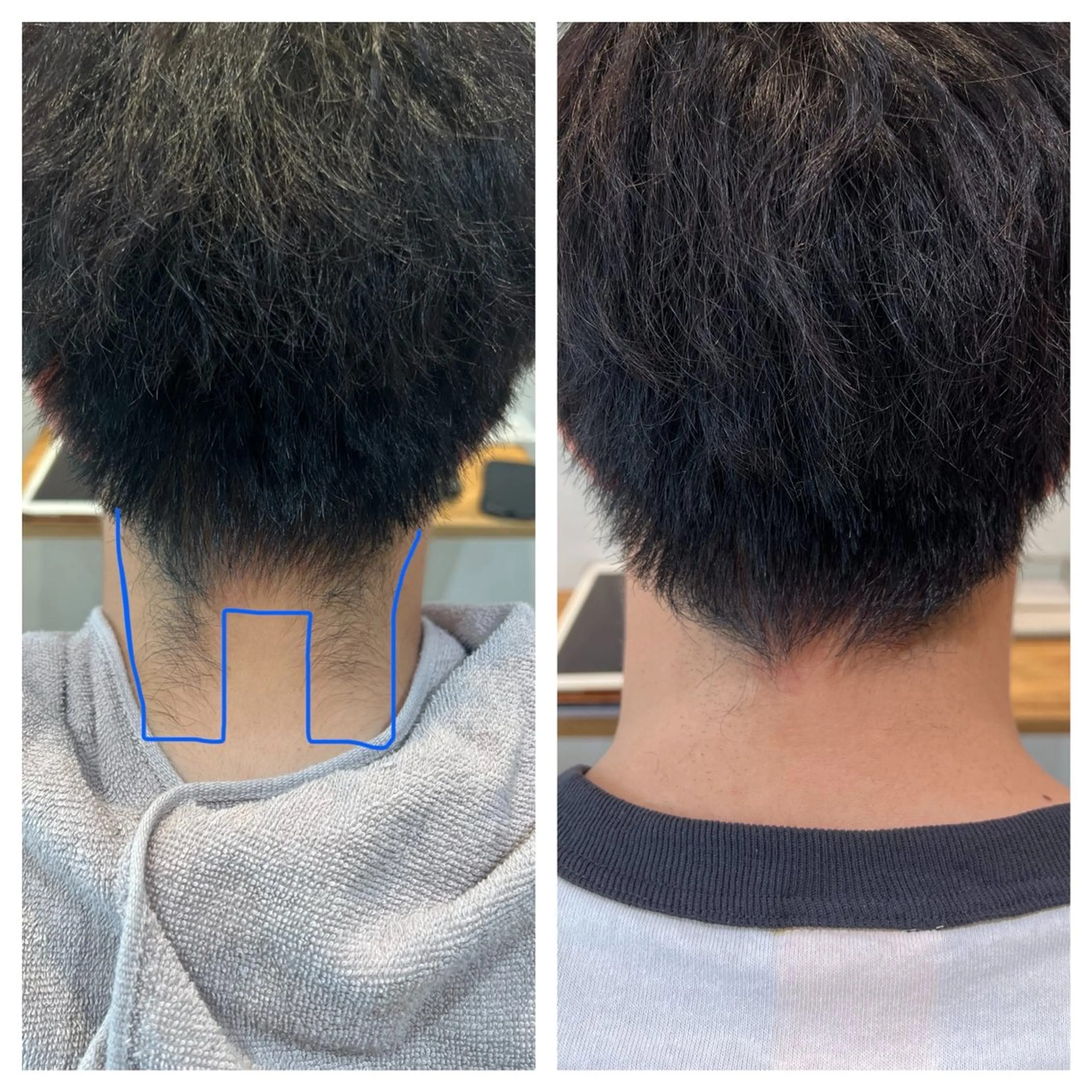 えりあし、うなじ脱毛の写真