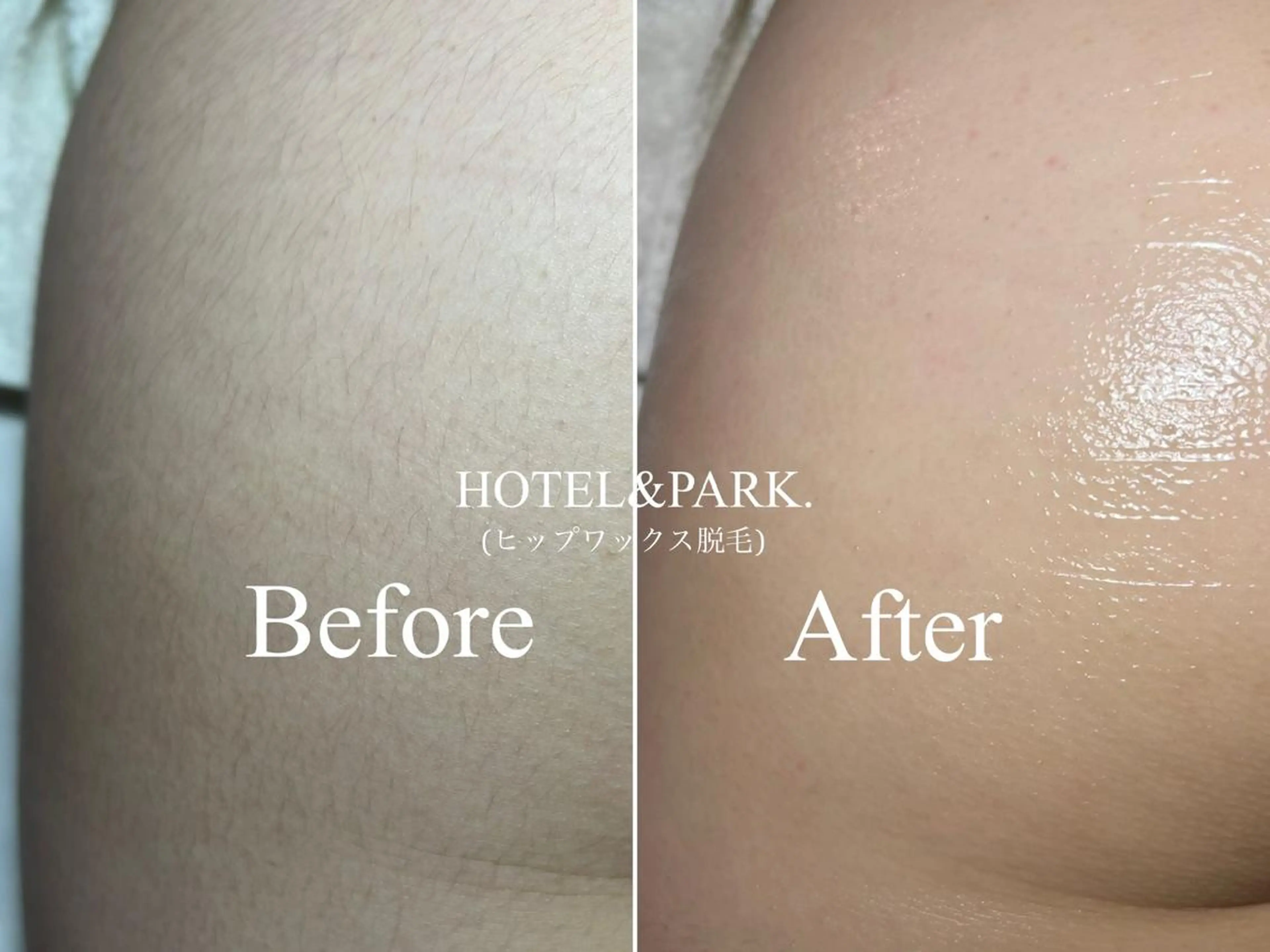 脱毛 HOTEL&PARK . ワックス脱毛のエステ・リラクイメージ