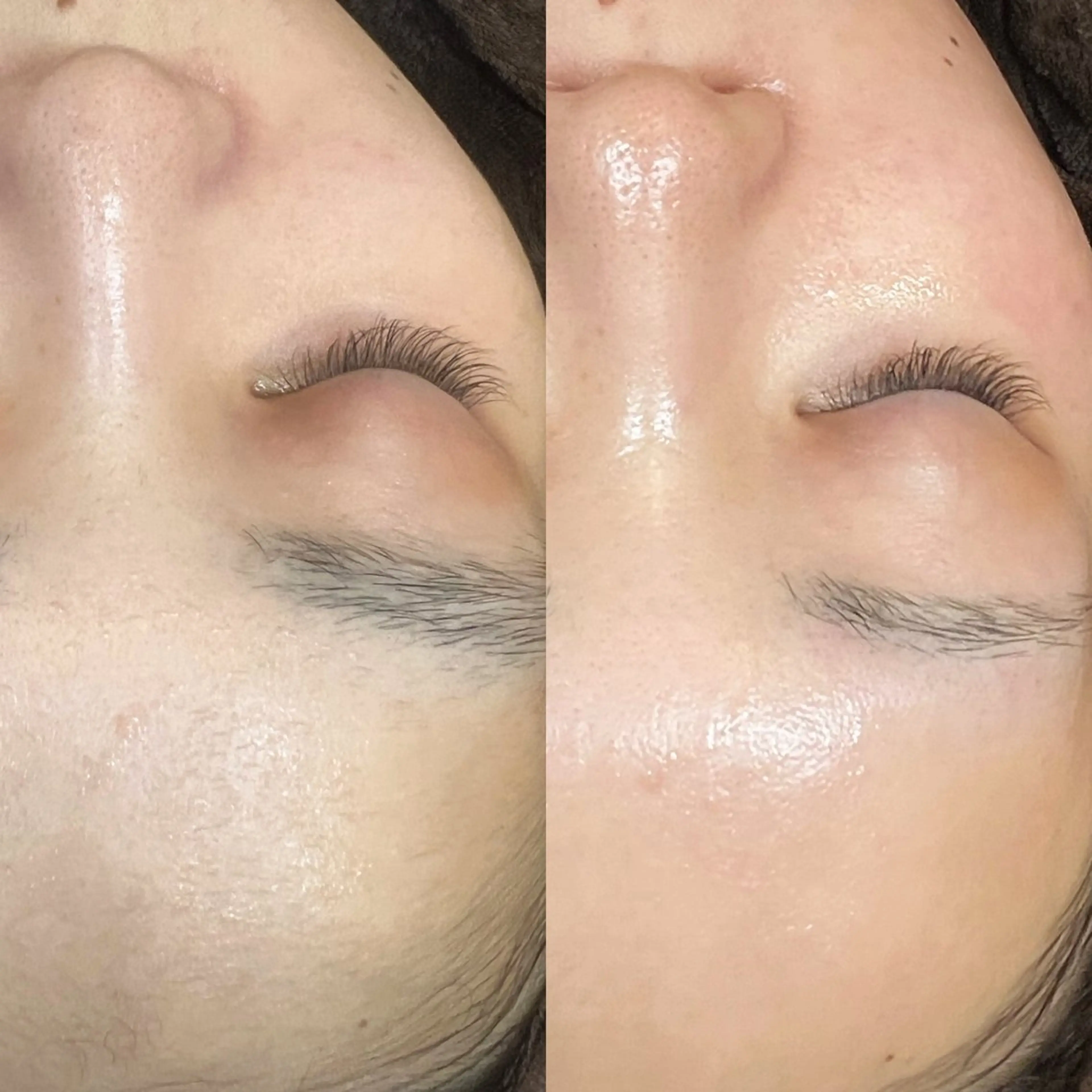 【minimo限定🩷】フェイシャル脱毛ワックス×産毛や角質除去 ✨即日効果あり⭕️の写真