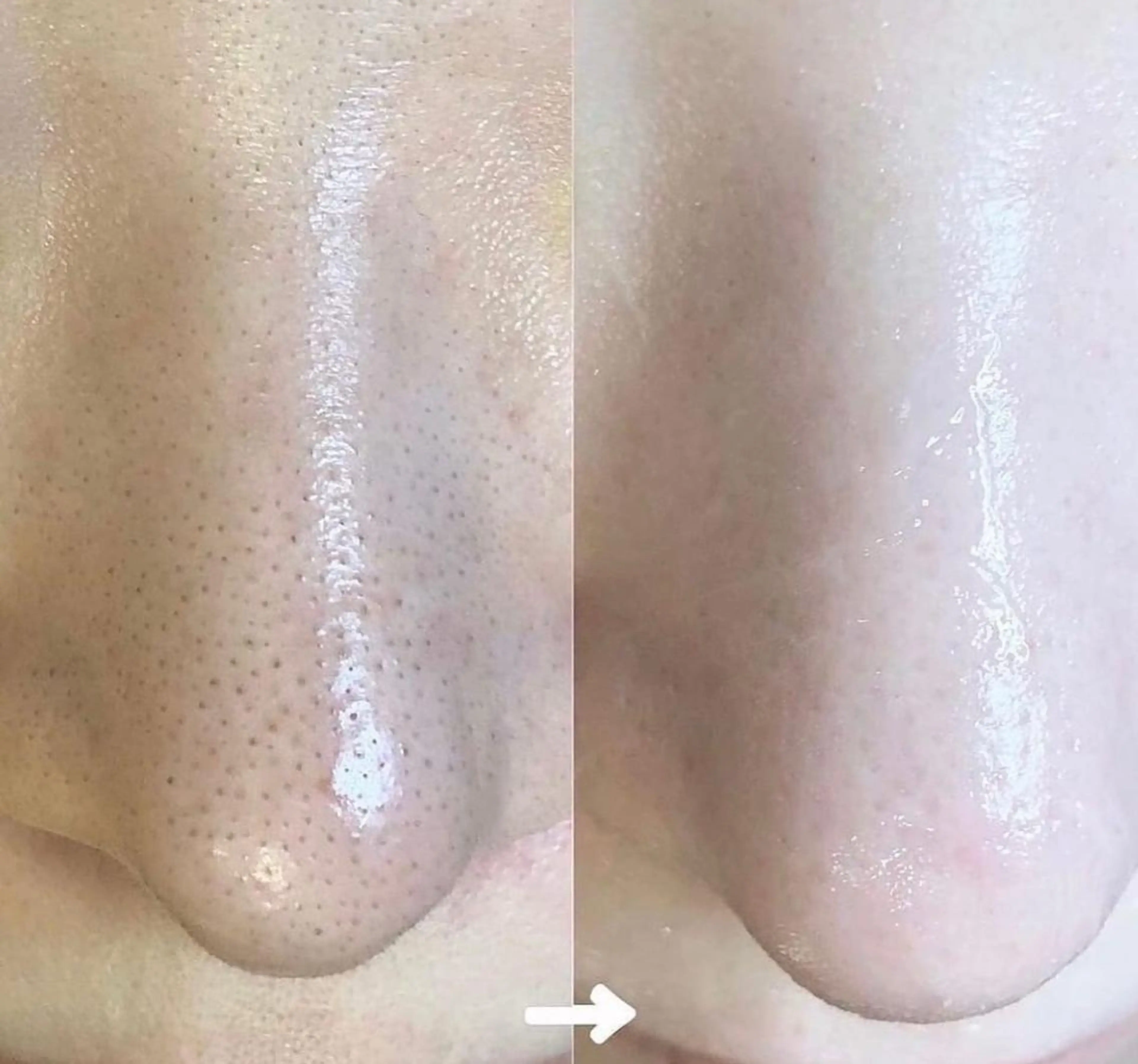 新年に向けて大掃除🧹毛穴撃退コース✨【ハイドラ✖️炭酸✖️プラズマ】皮脂黒ずみつまり開きが気になる方にオススメ🤍の写真