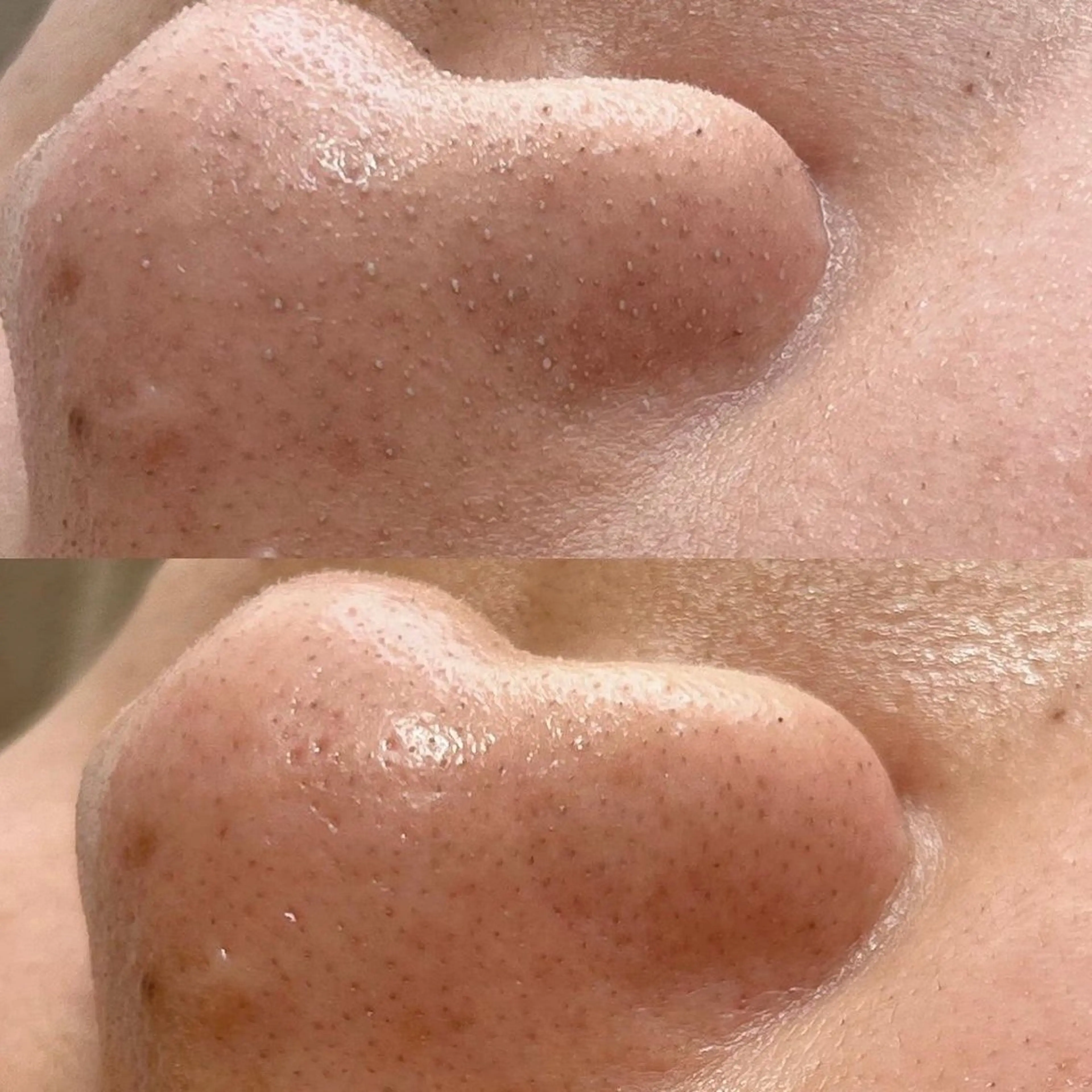 《🔥新メニュー50%off🔥》メンズフェイシャル◆ハイドラ毛穴洗浄・ニキビケア・毛穴ケア🫧 \6600の写真